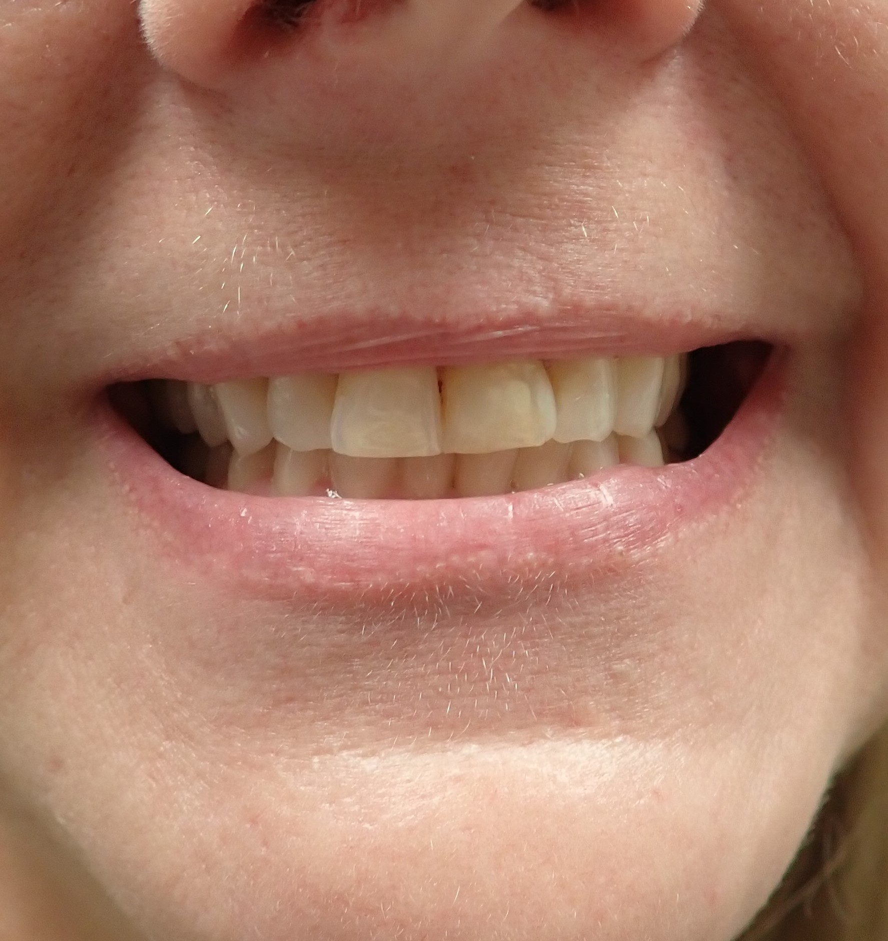 Close up of patients teeth