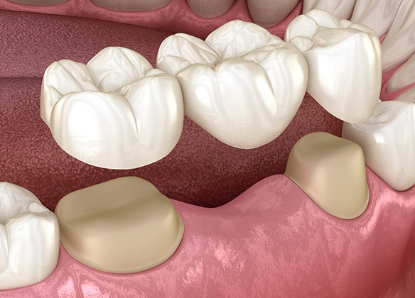 Diagram of dental bridge being placed