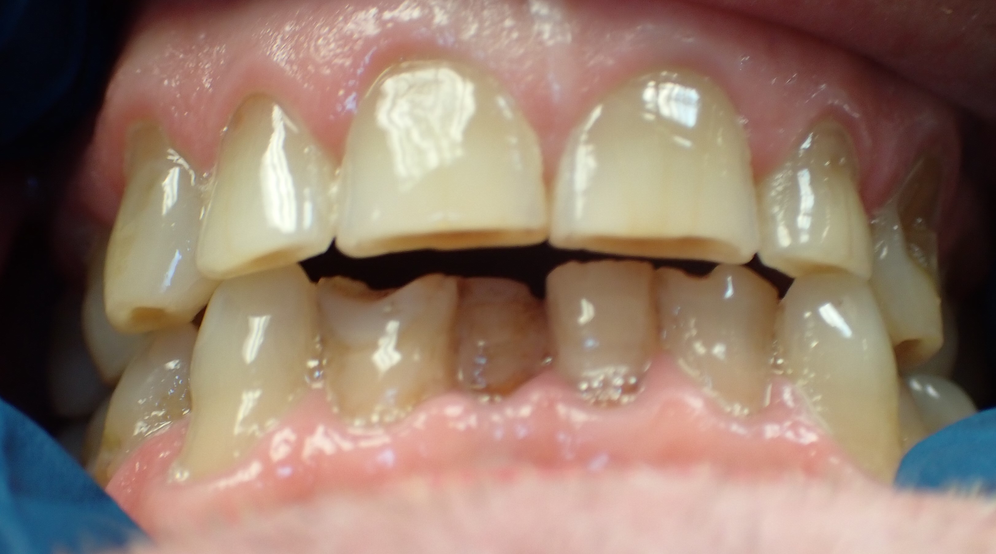 Close up of damaged teeth