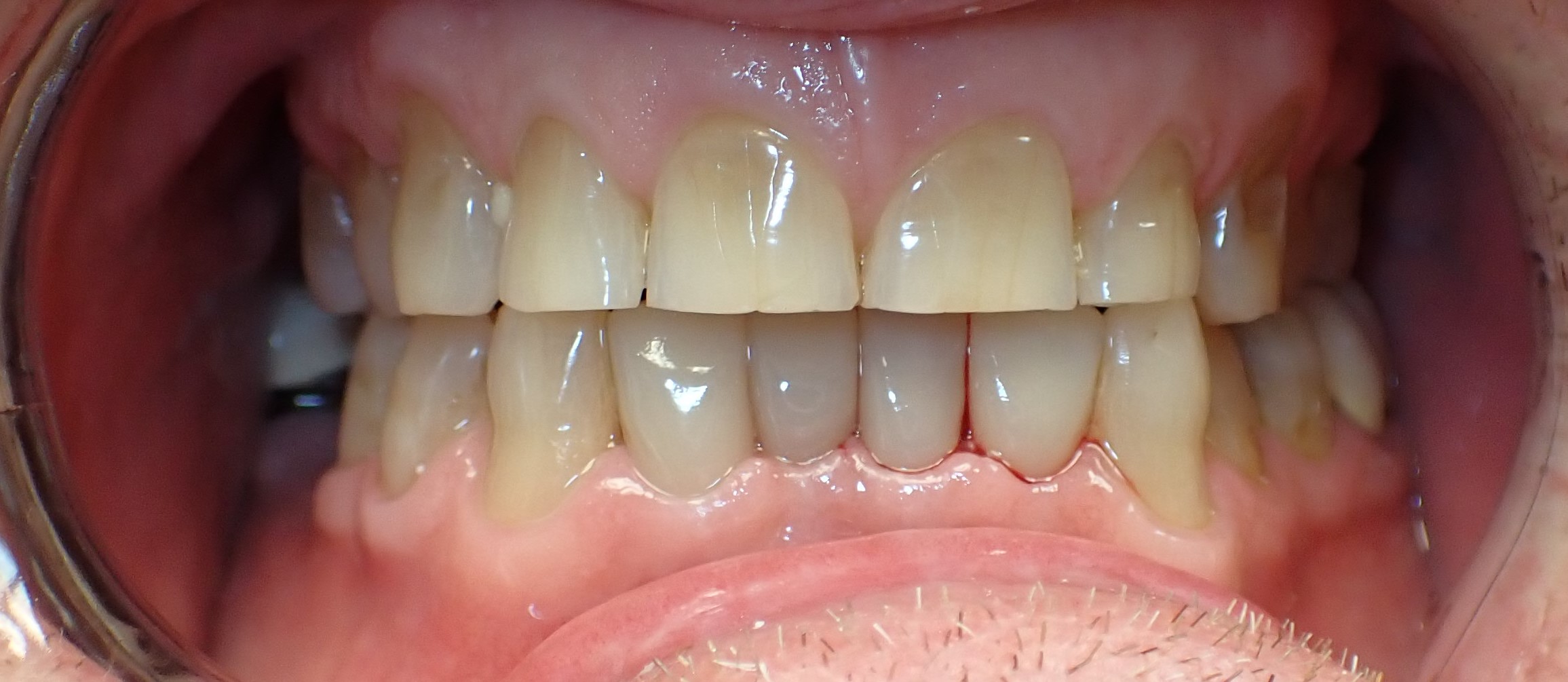 Close up of teeth after treatment