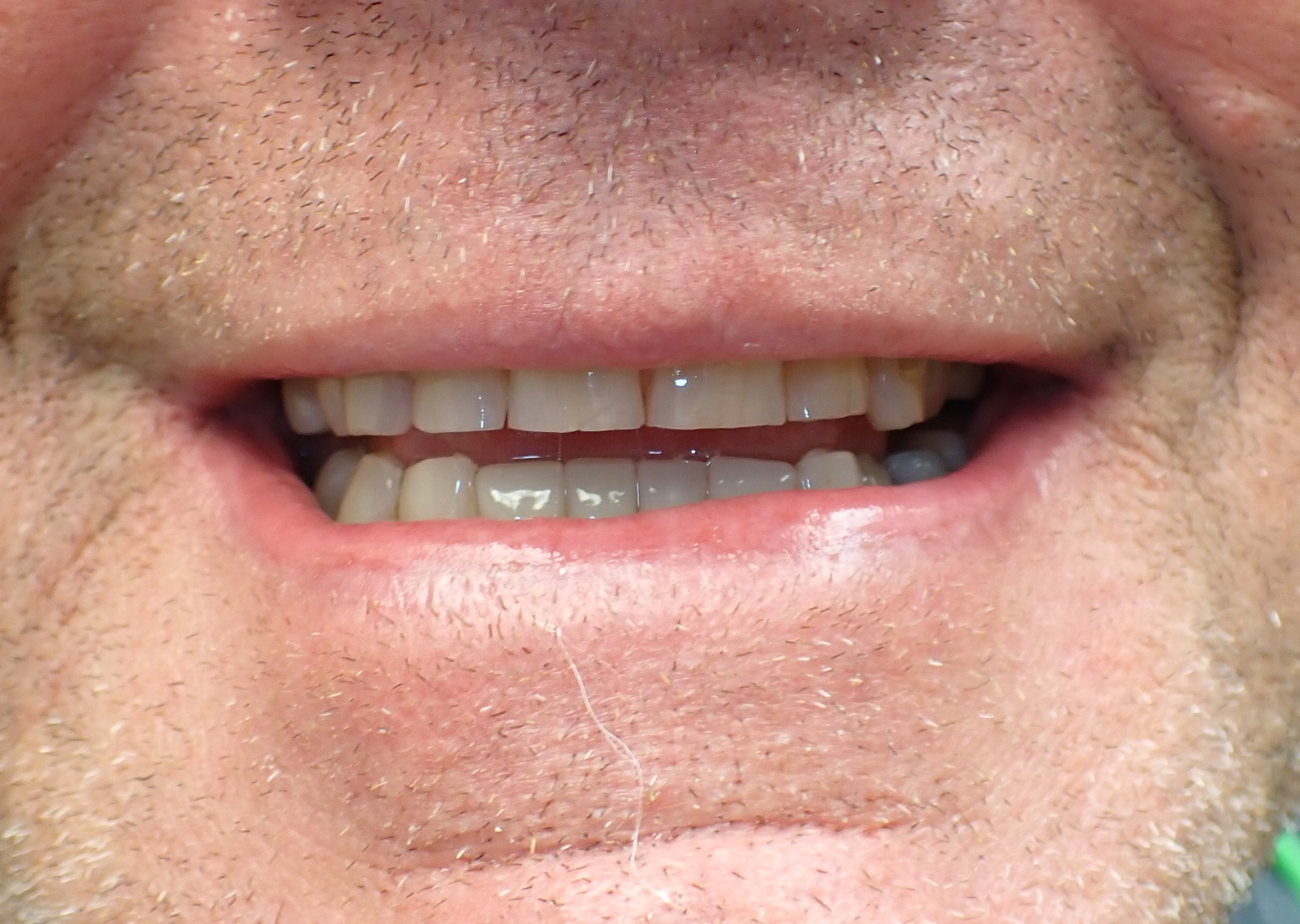 Mans mouth after receiving dental crowns