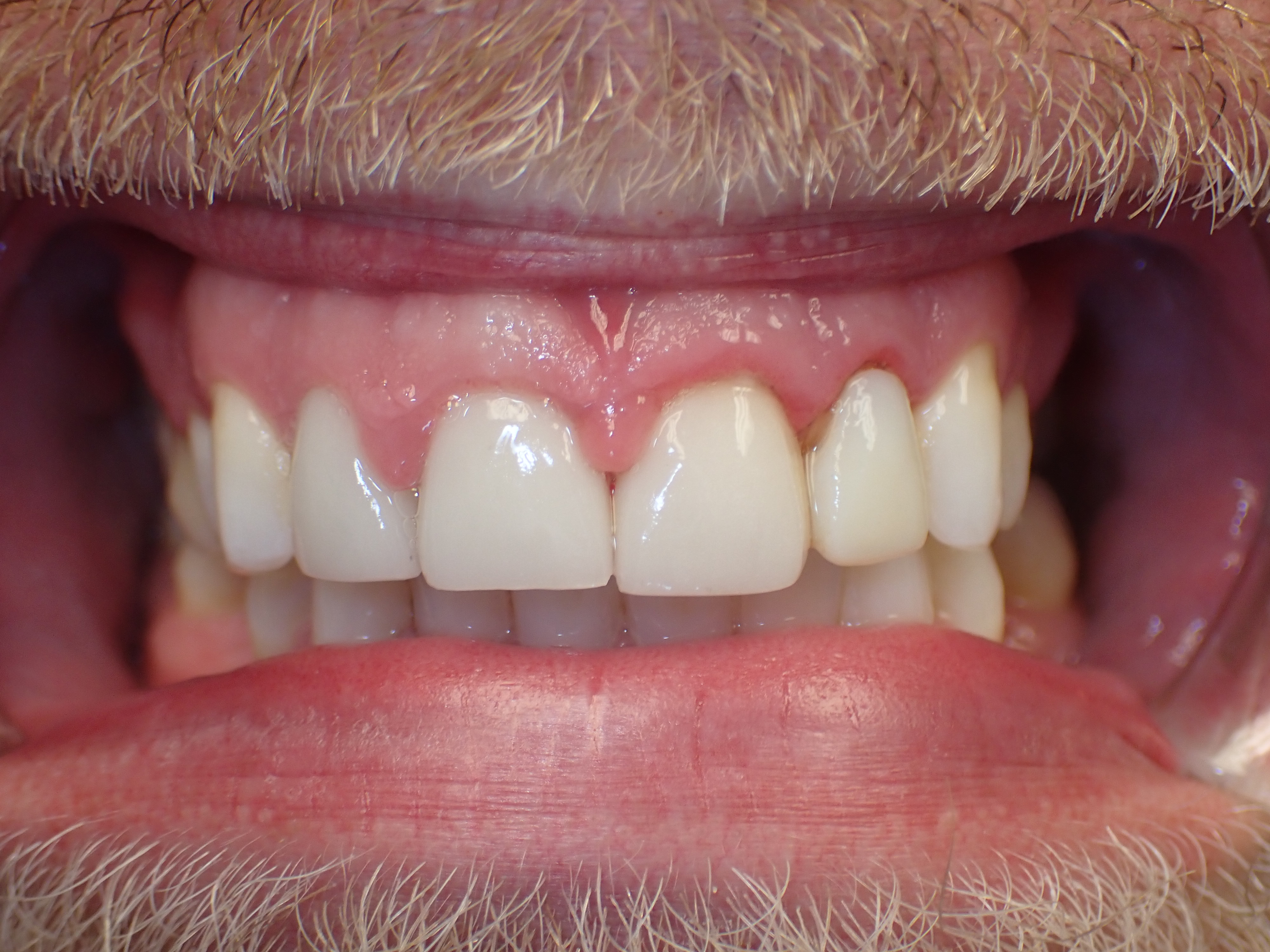 Close up of worn down front teeth