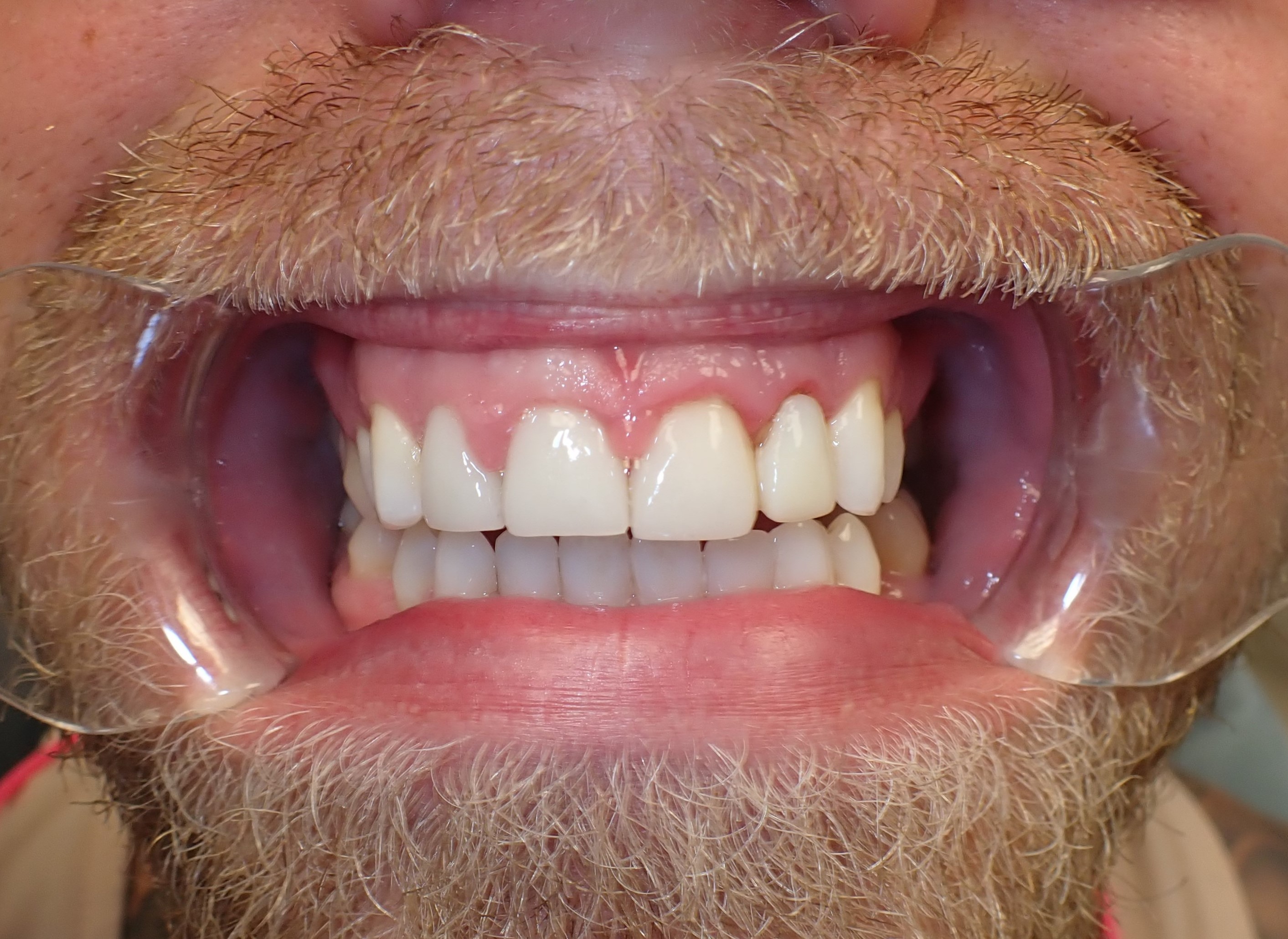 Farther shot of worn down front teeth