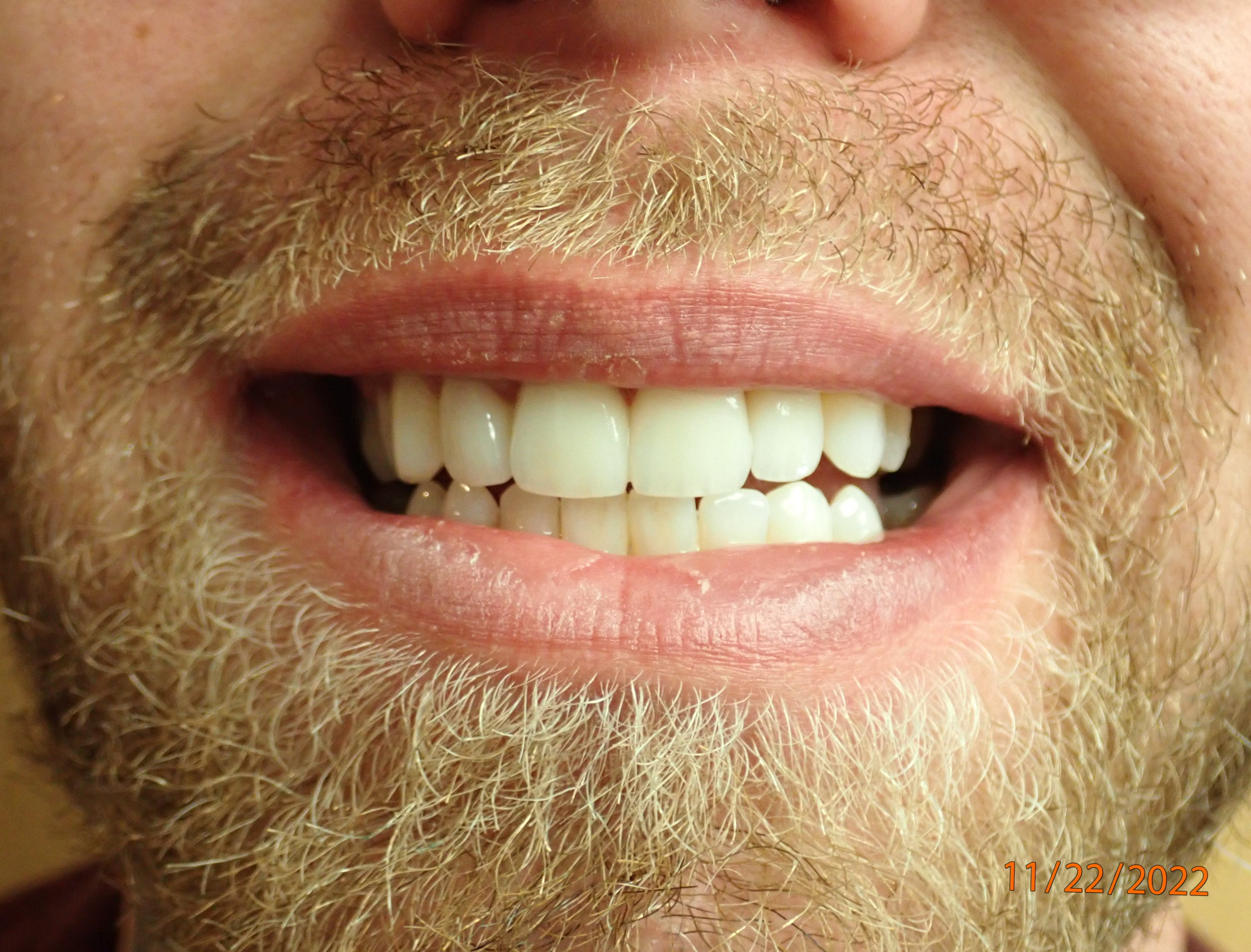 Teeth after receiving dental crowns