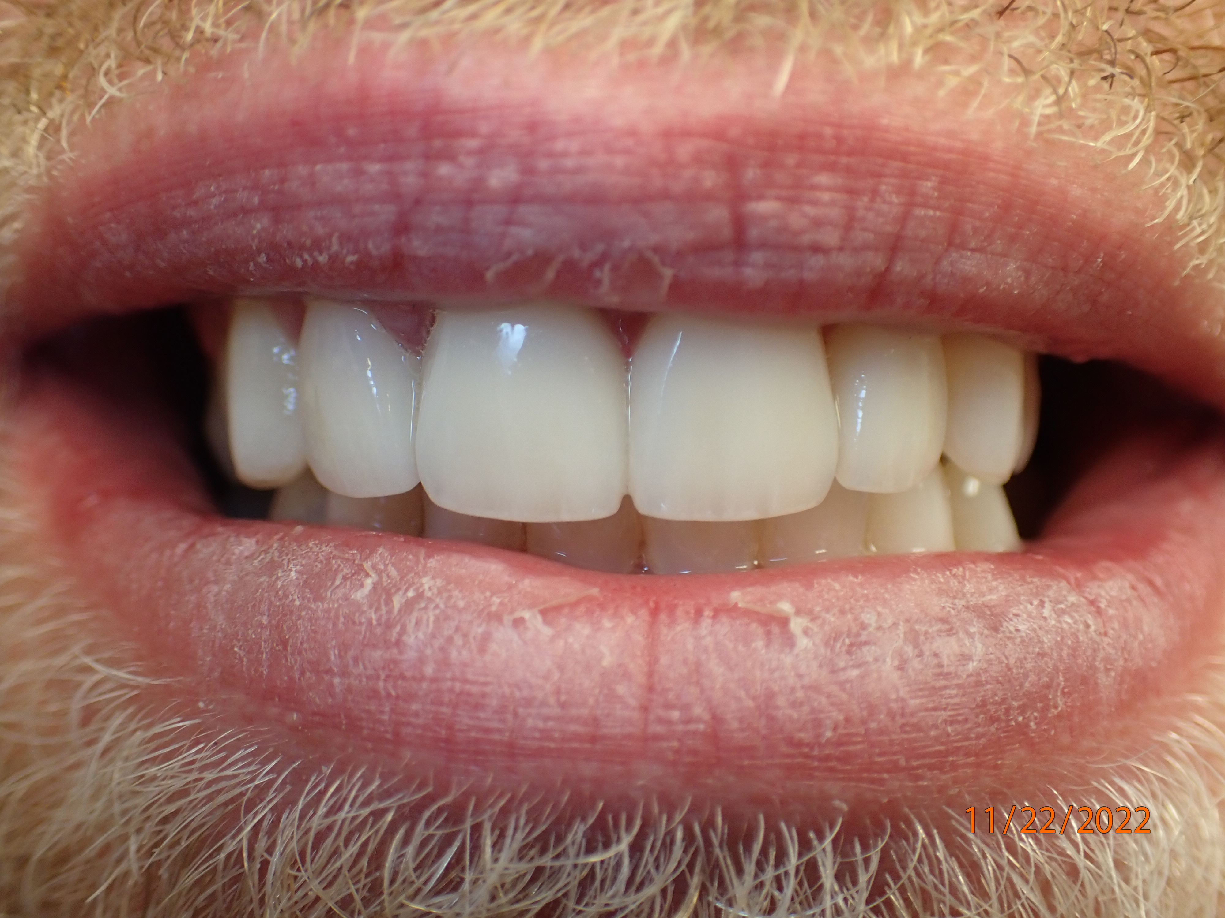 Farther shot of teeth after receiving dental crowns