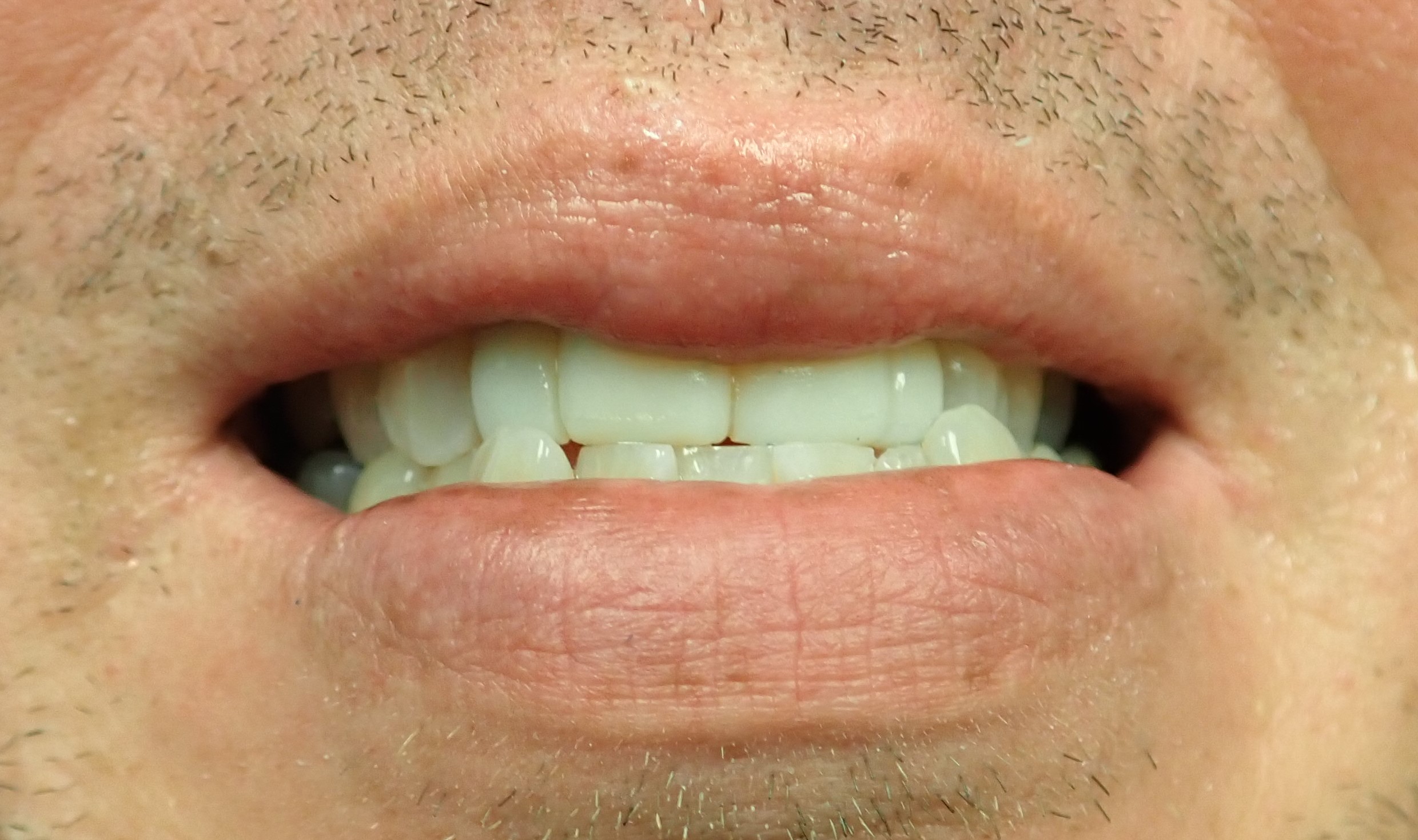 Close up of smile in need of cosmetic crowns