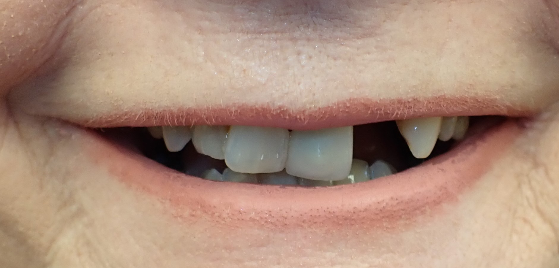 Gap in smile left by missing tooth