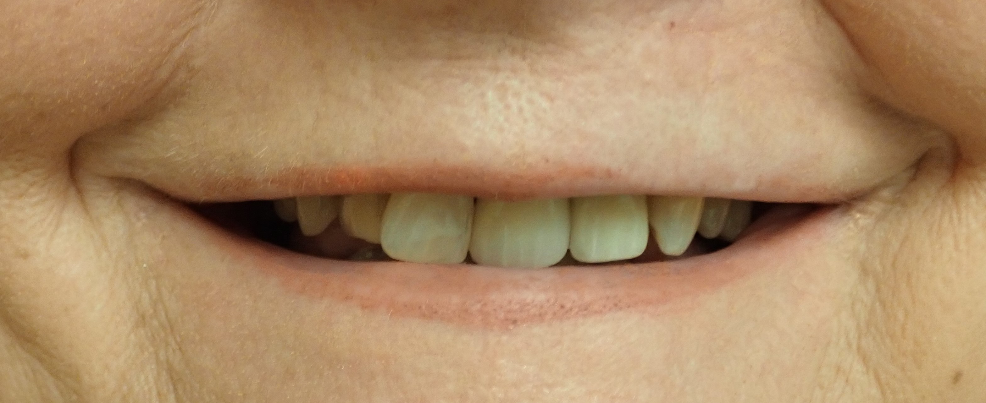 Close up of teeth after getting a dental implant