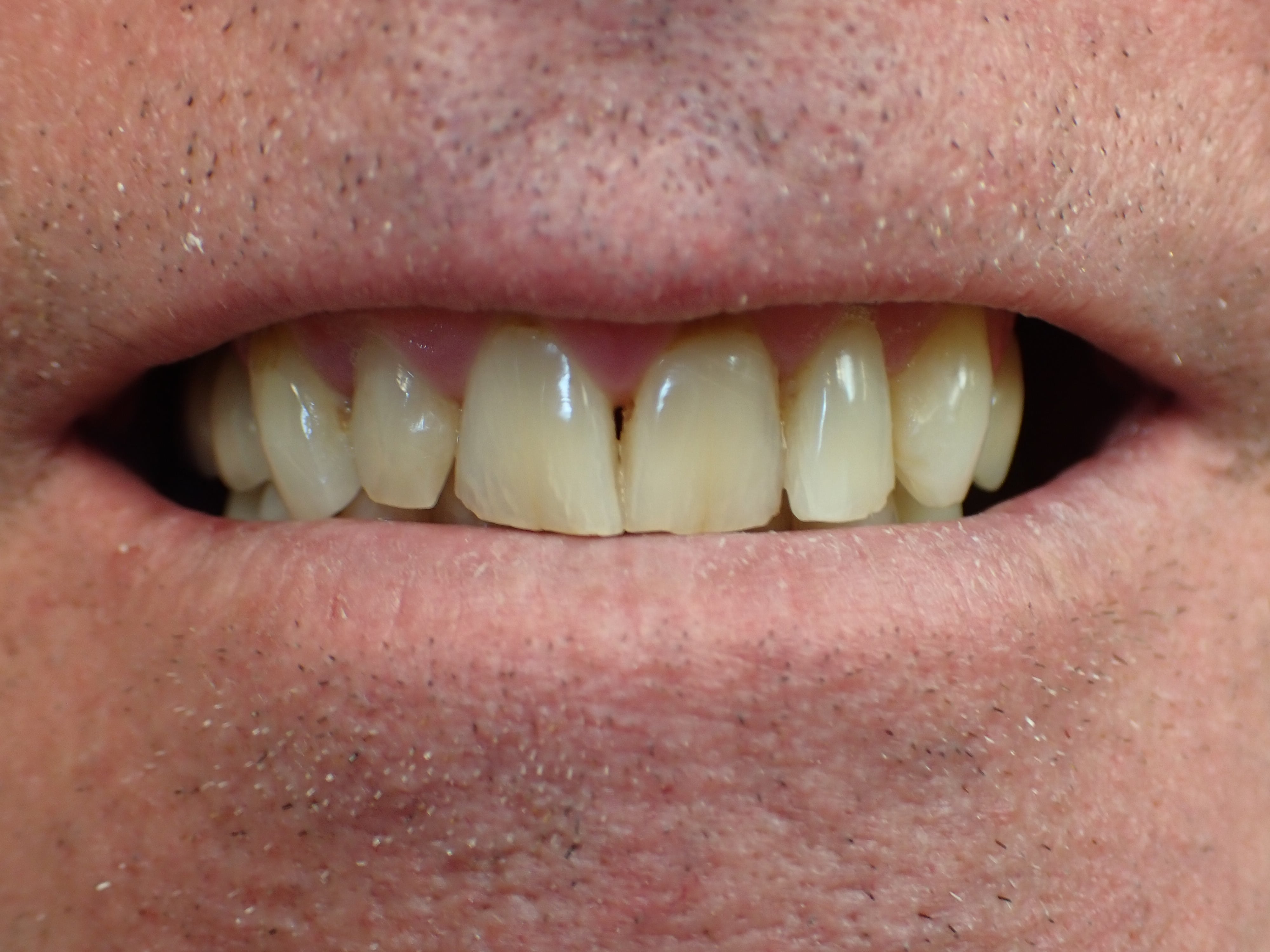 Close up of patients teeth