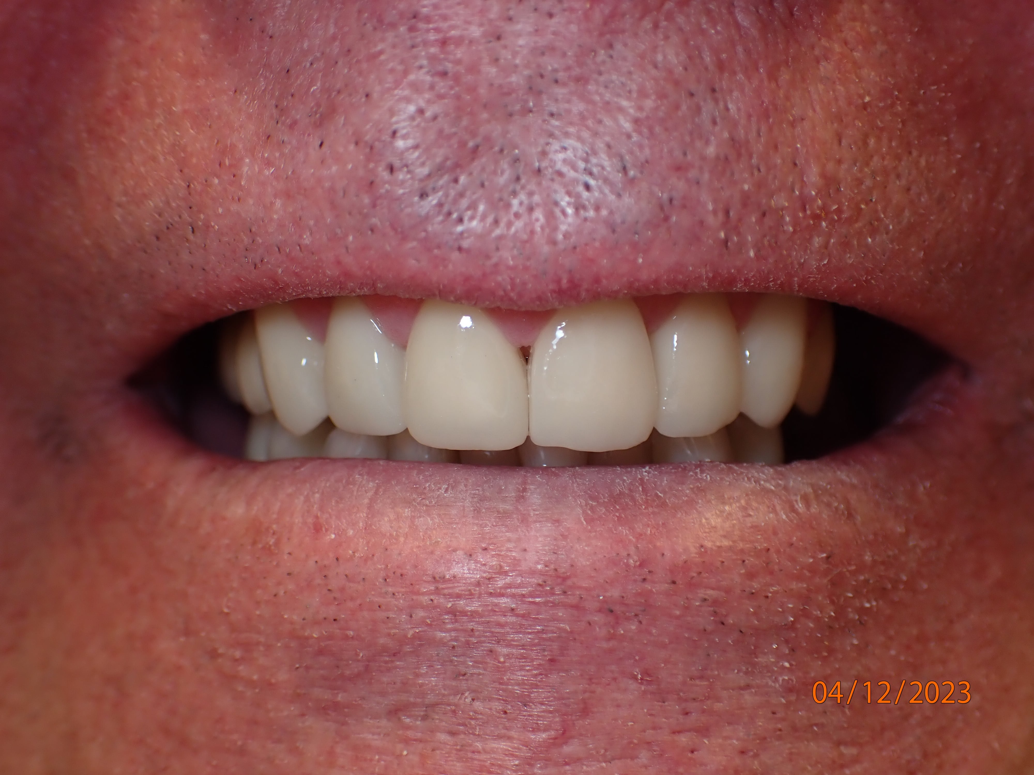 Close up of teeth after treatment