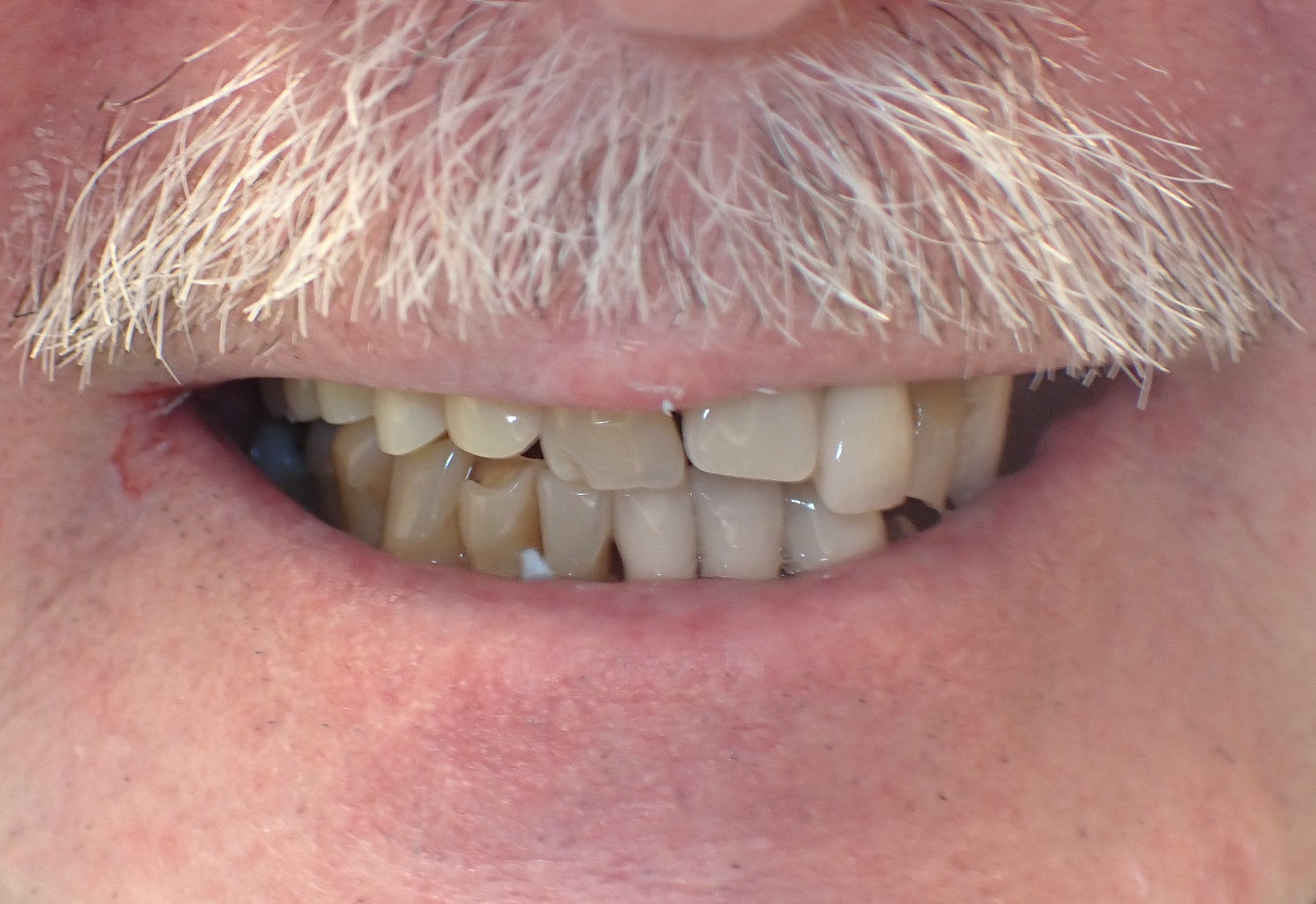 Close up of misaligned teeth