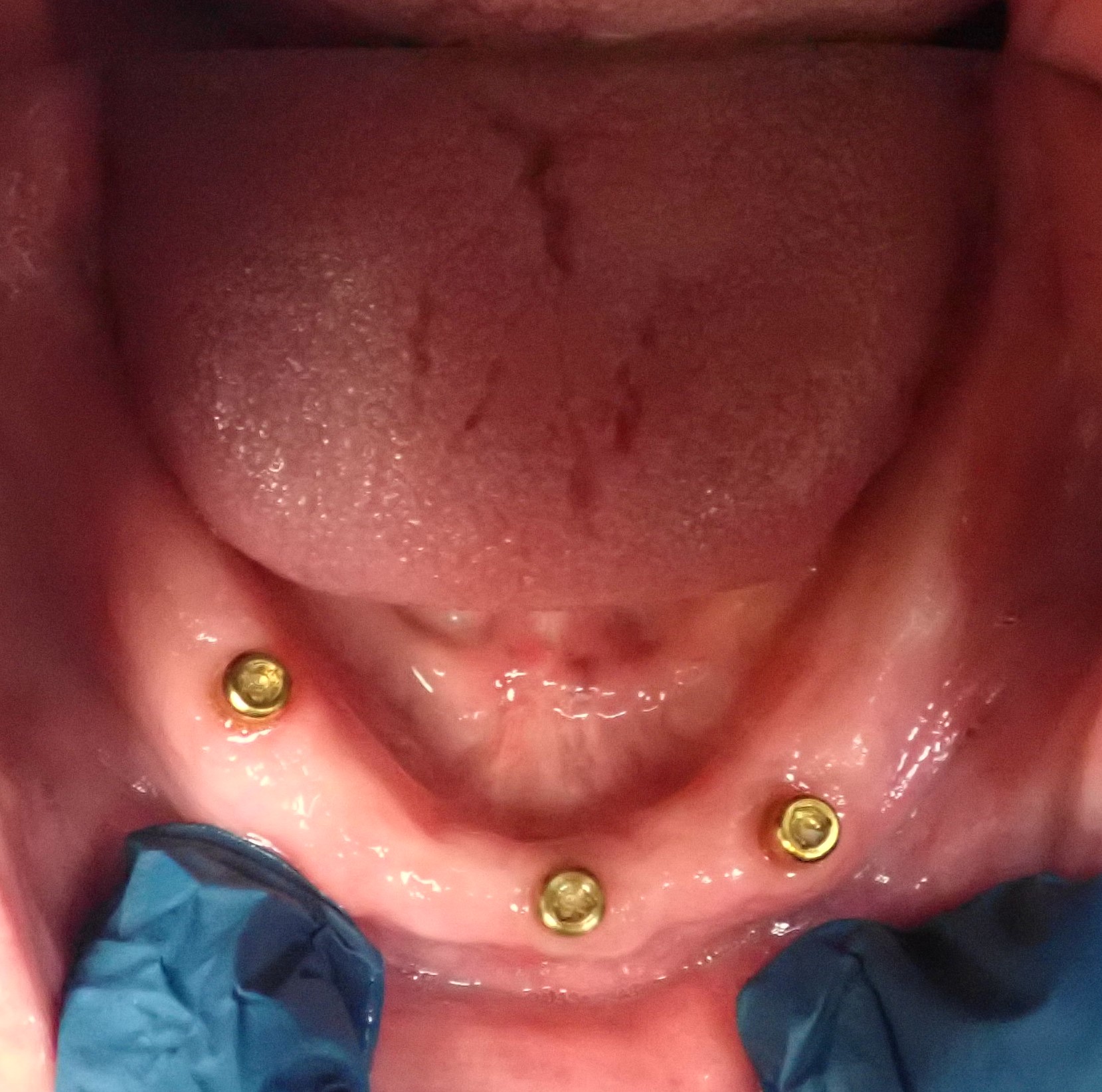 Overhead view of implants in gums