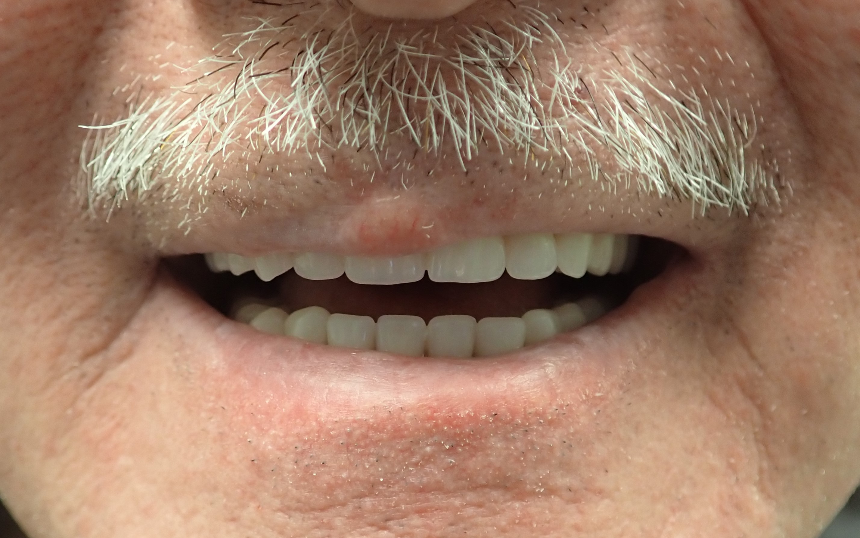 Mans smile after getting implant dentures