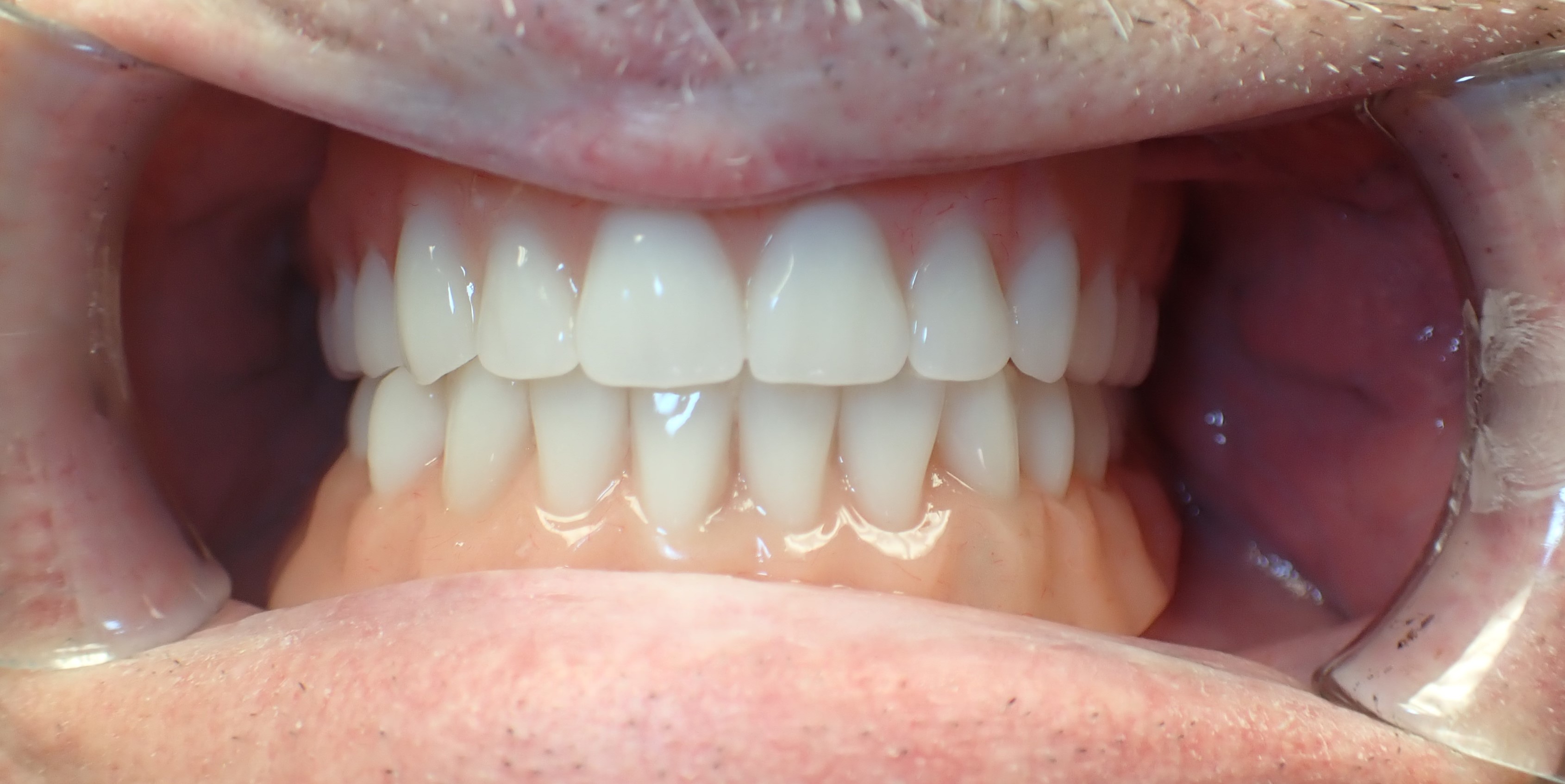 Teeth after implant dentures have been placed