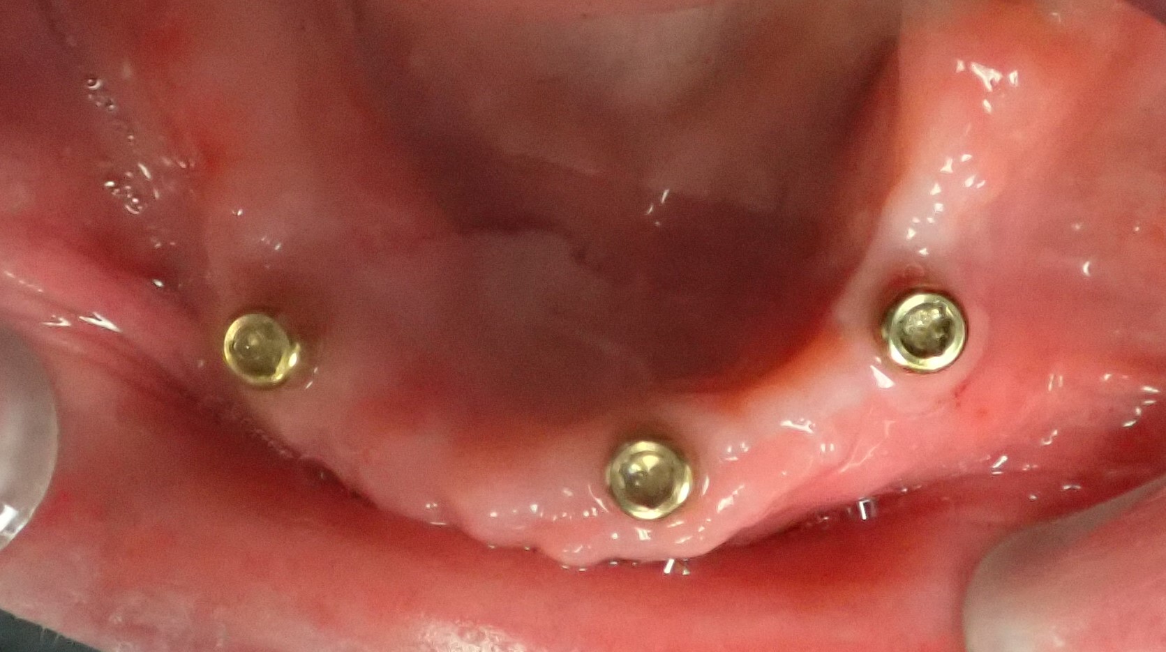 Close up of bottom of implant denture