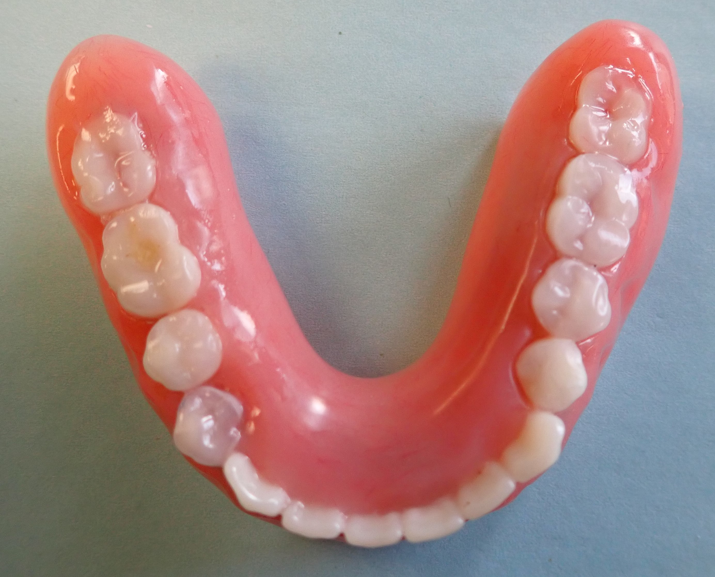 Implant dentures viewed from the top