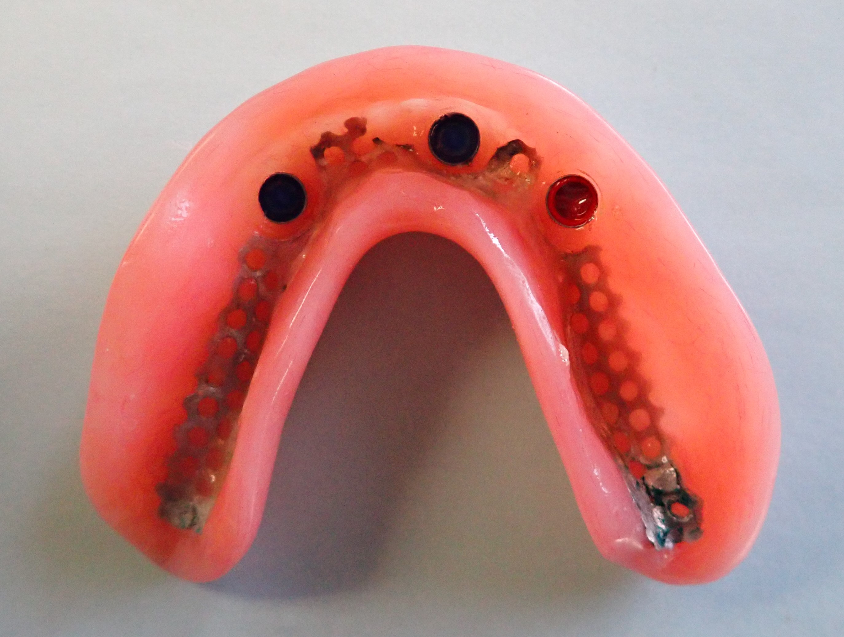 Overhead view of inside of implant denture