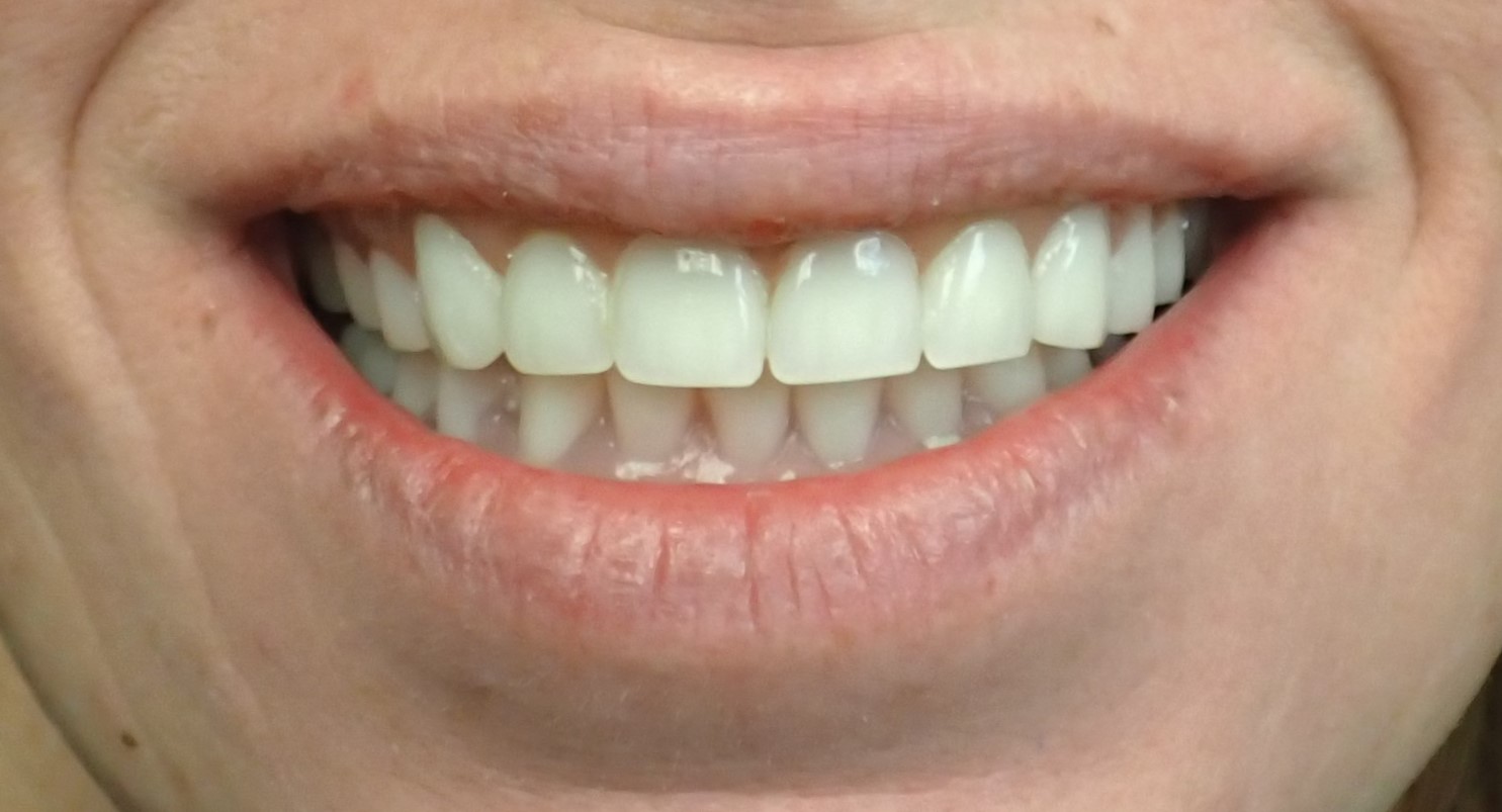 Smile restored with implant dentures