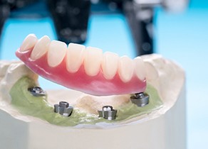 Model of an implant denture