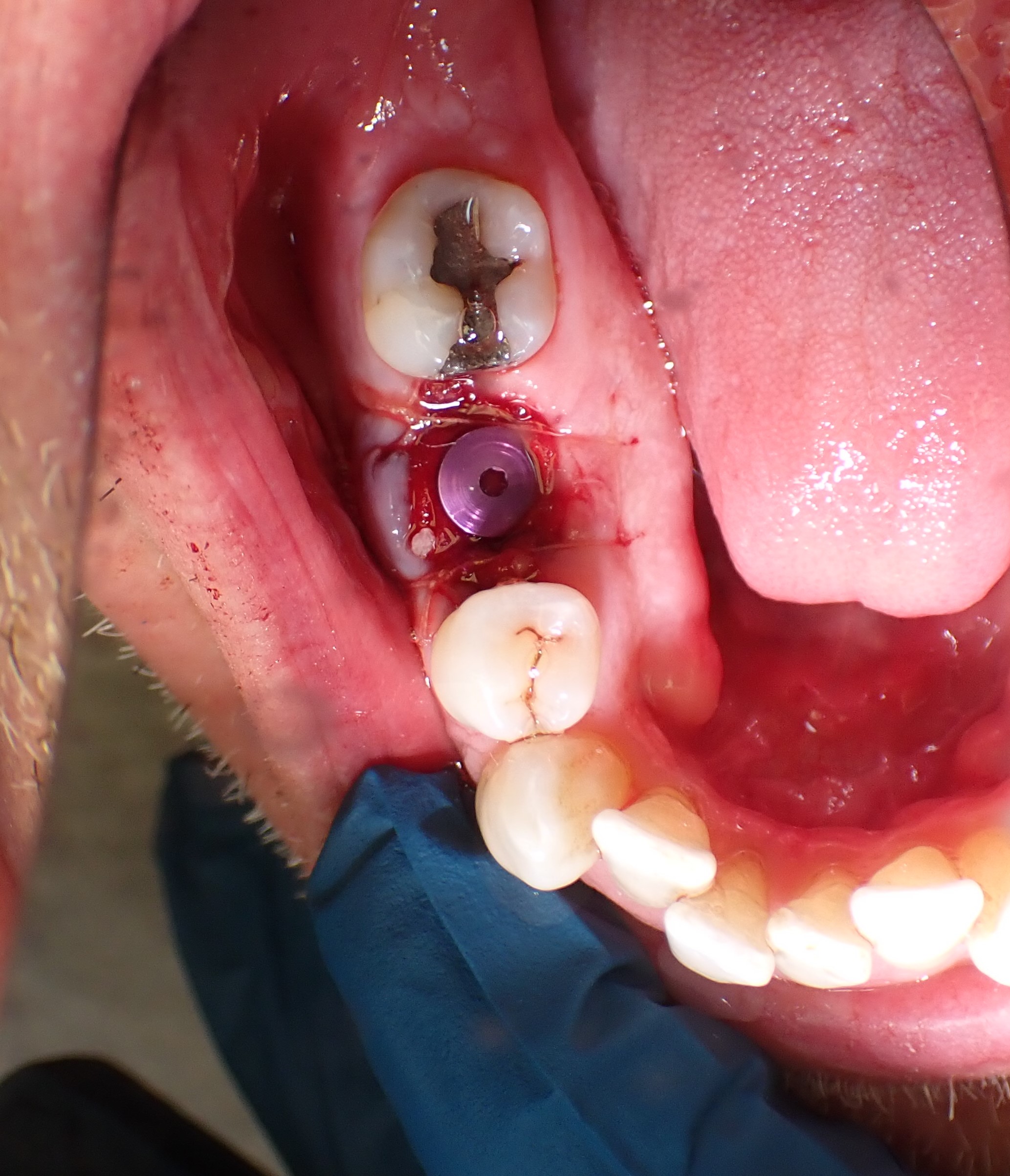 Overhead shot of tooth with filling and piece of metal in gums