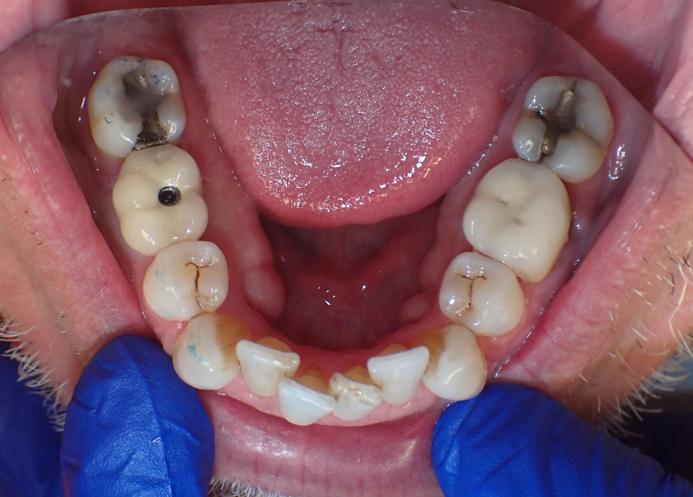 Overhead shot of multiple misaligned teeth