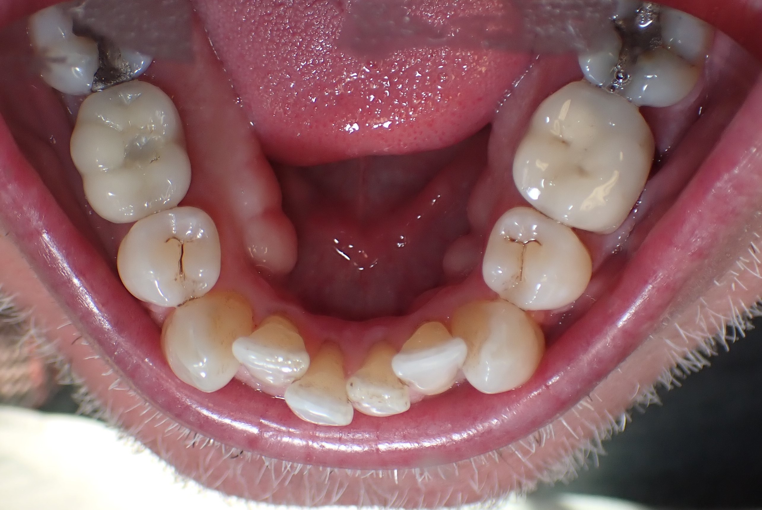 Close up of misaligned teeth