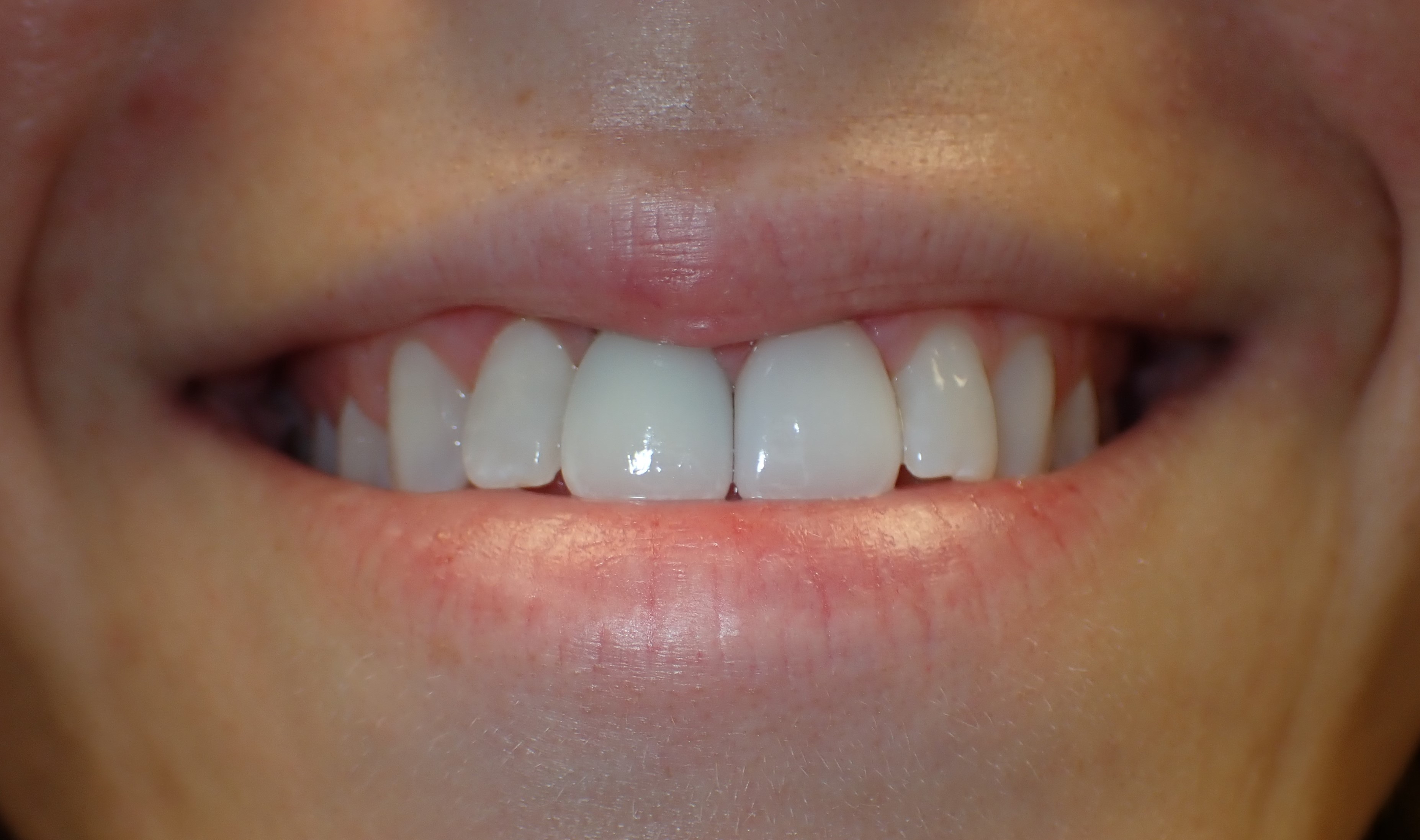 Tooth replaced with a dental implant