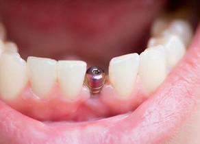 Close up of mouth with dental implant and abutment