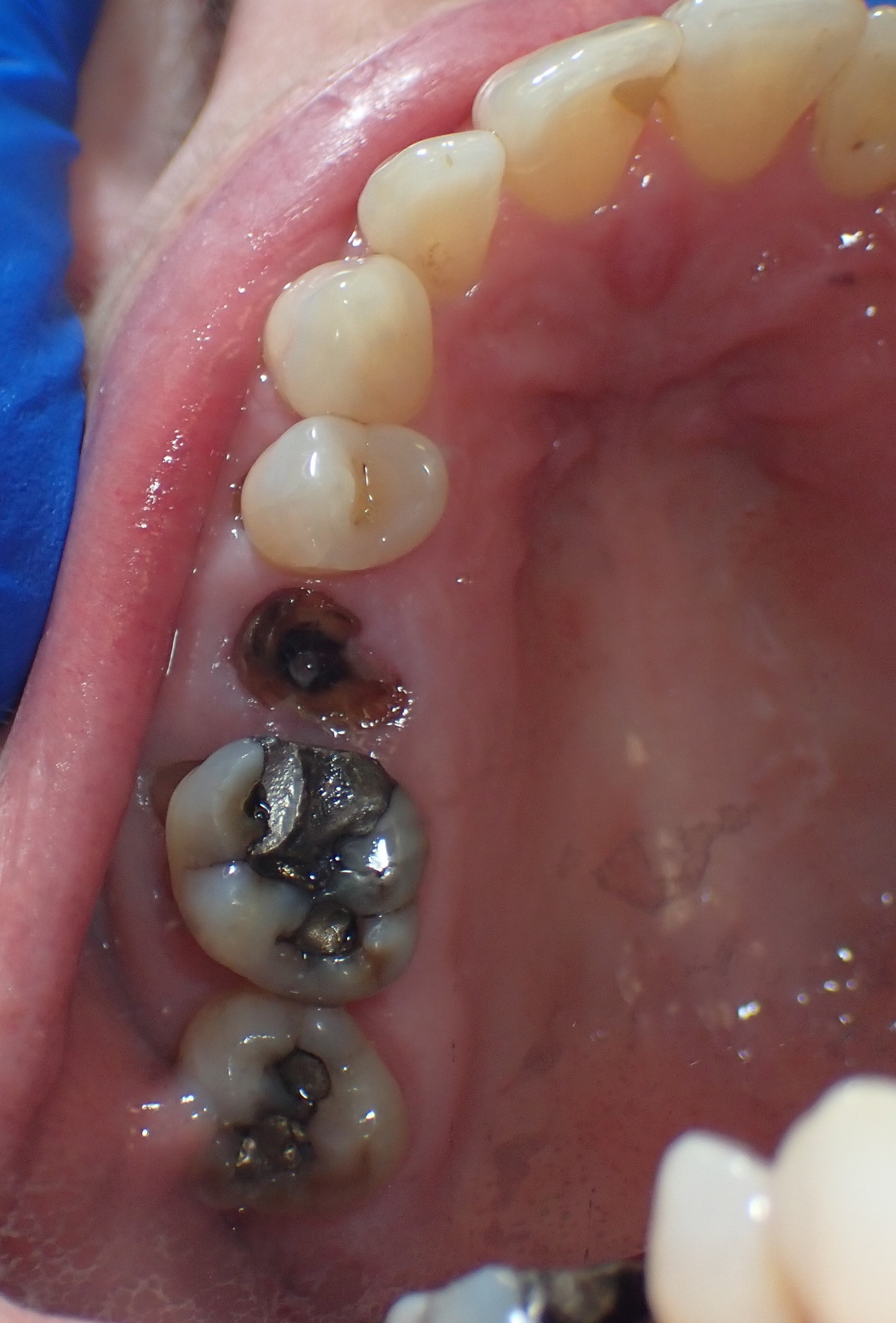 Missing tooth and tooth with metal filling