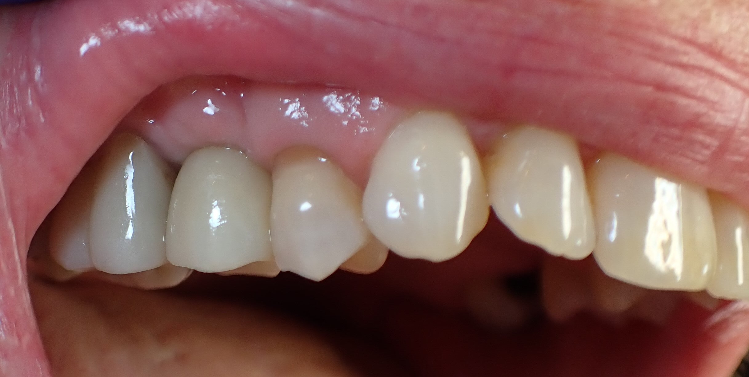 Close up of teeth after dental implants were placed