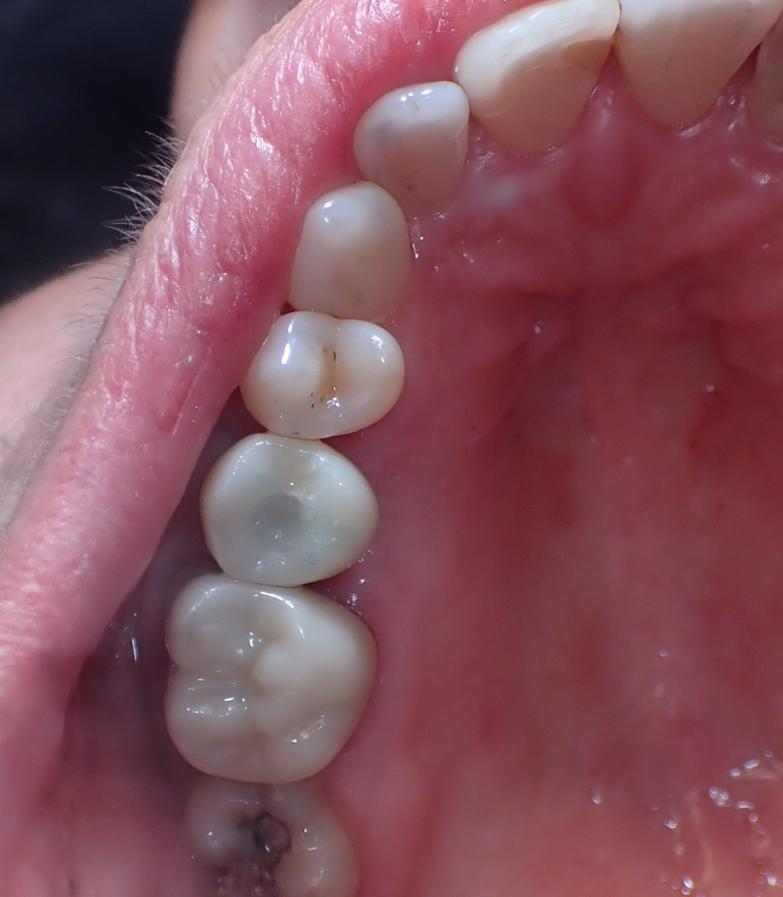 View of teeth from bottom after receiving dental implants