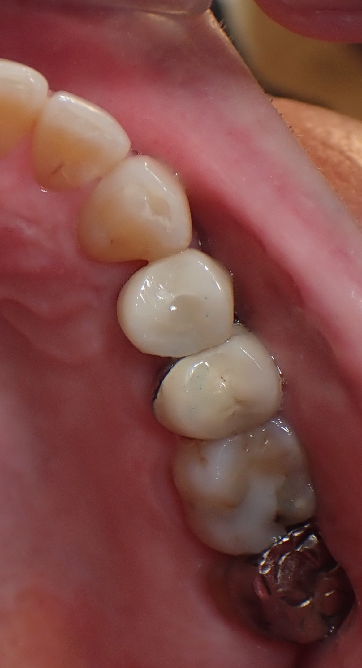 Close up of gap filled by dental implant