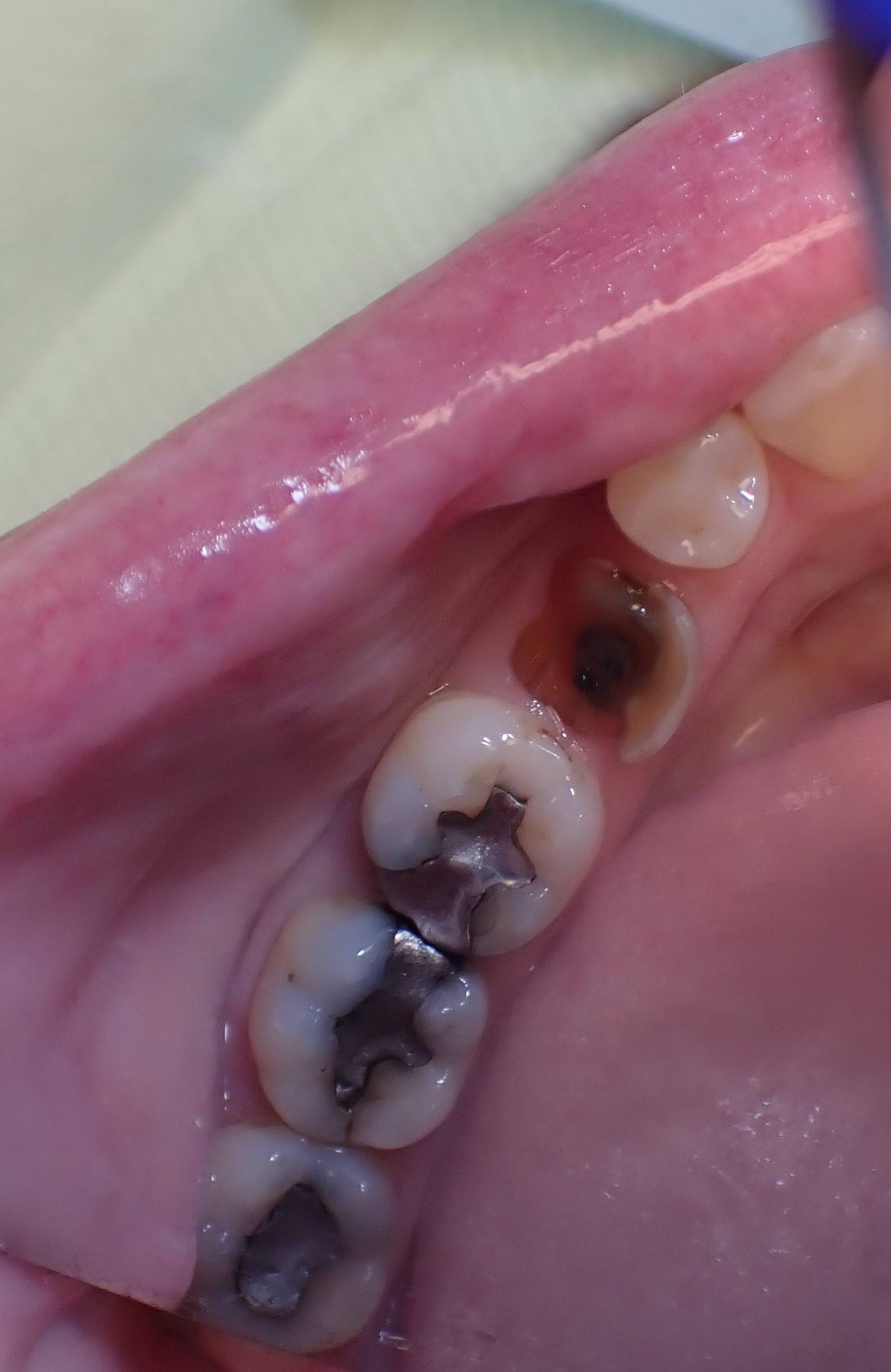 Teeth with fillings and empty tooth socket