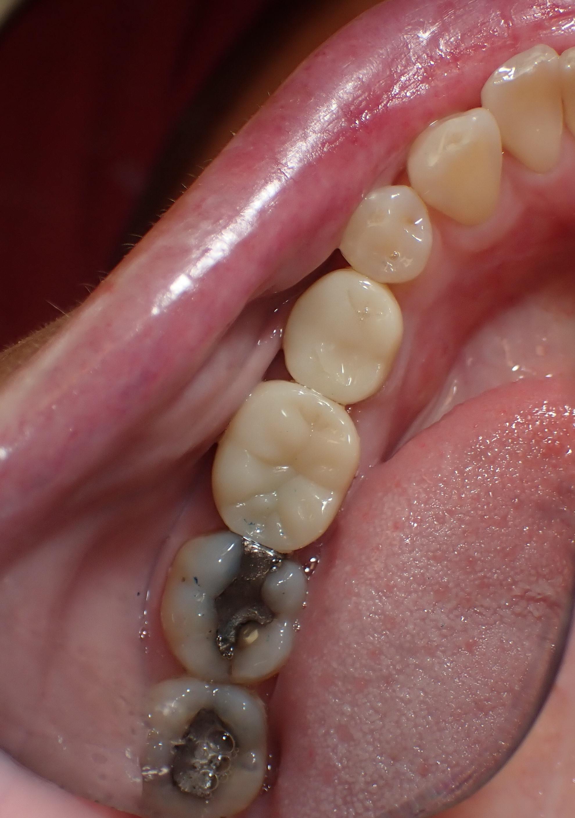 Tooth socket filled with dental implant