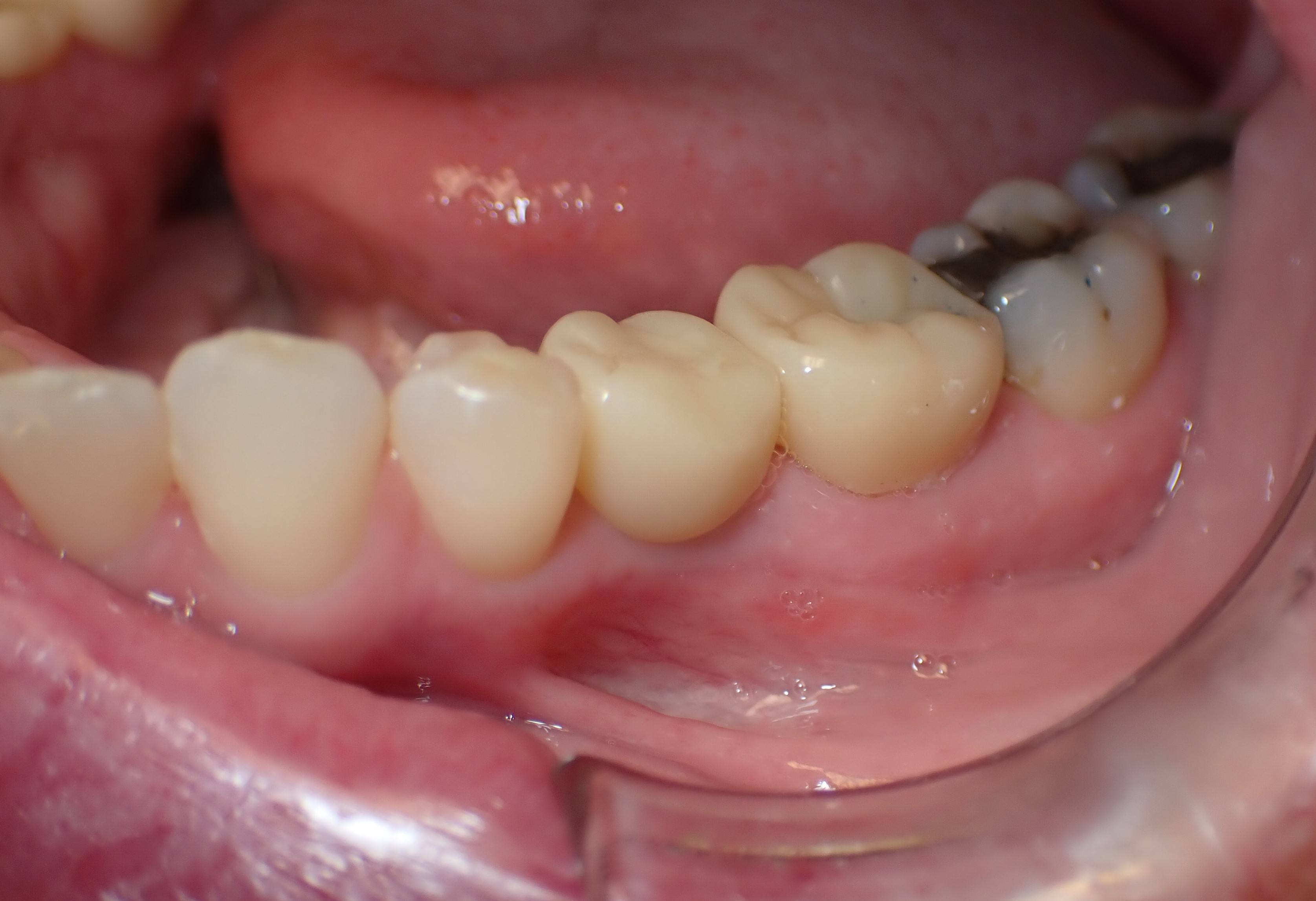 Side view of teeth after dental implant placement