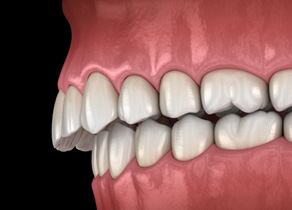 Illustration of an overbite