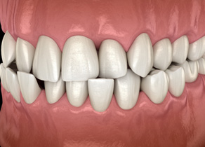 Illustration of a crossbite