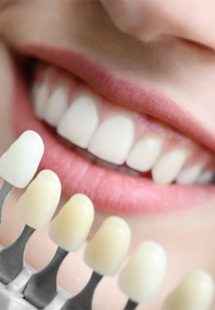 Color-matching a woman’s teeth for cosmetic dentistry