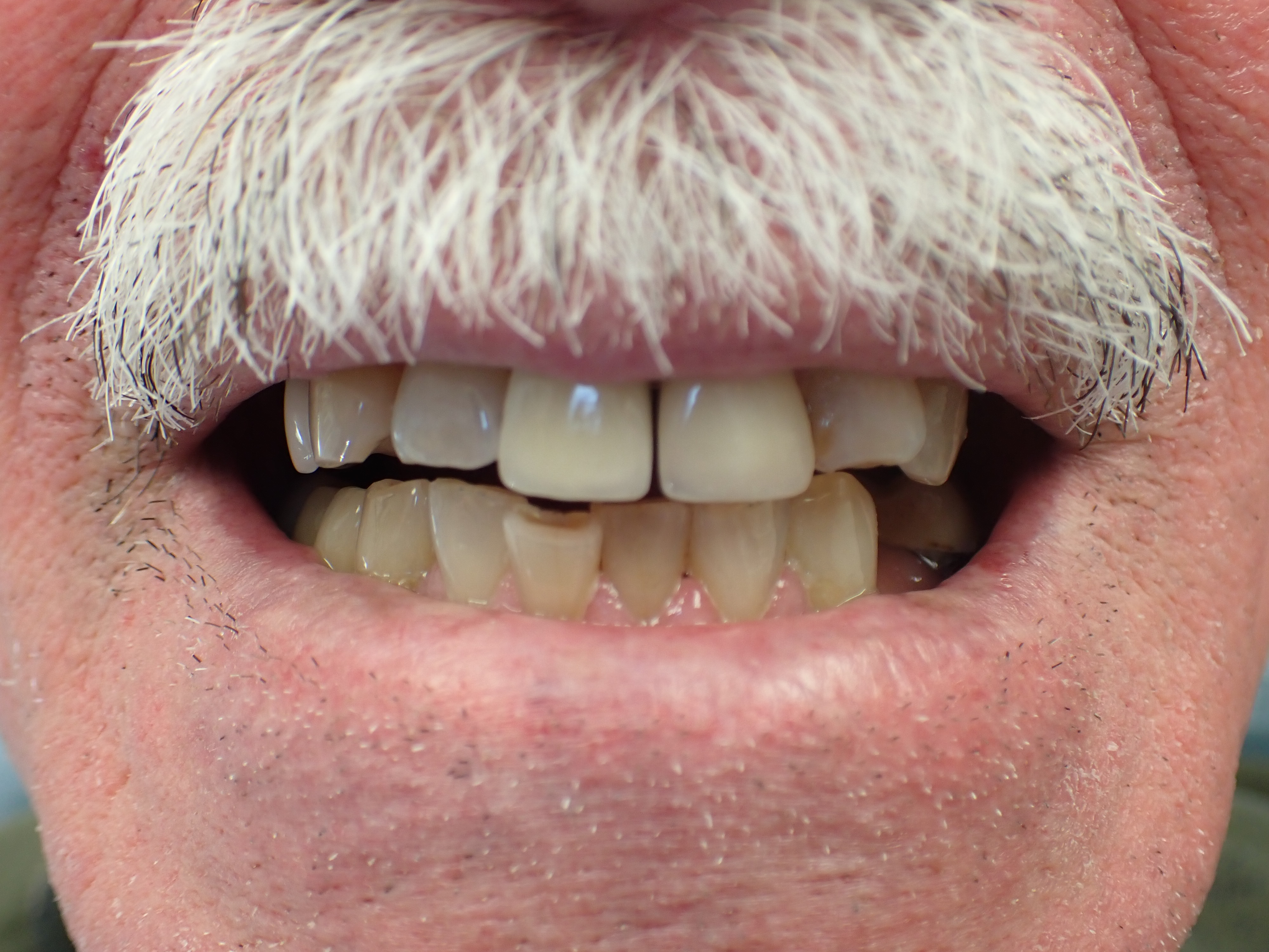 Man with gaps between teeth and misaligned teeth