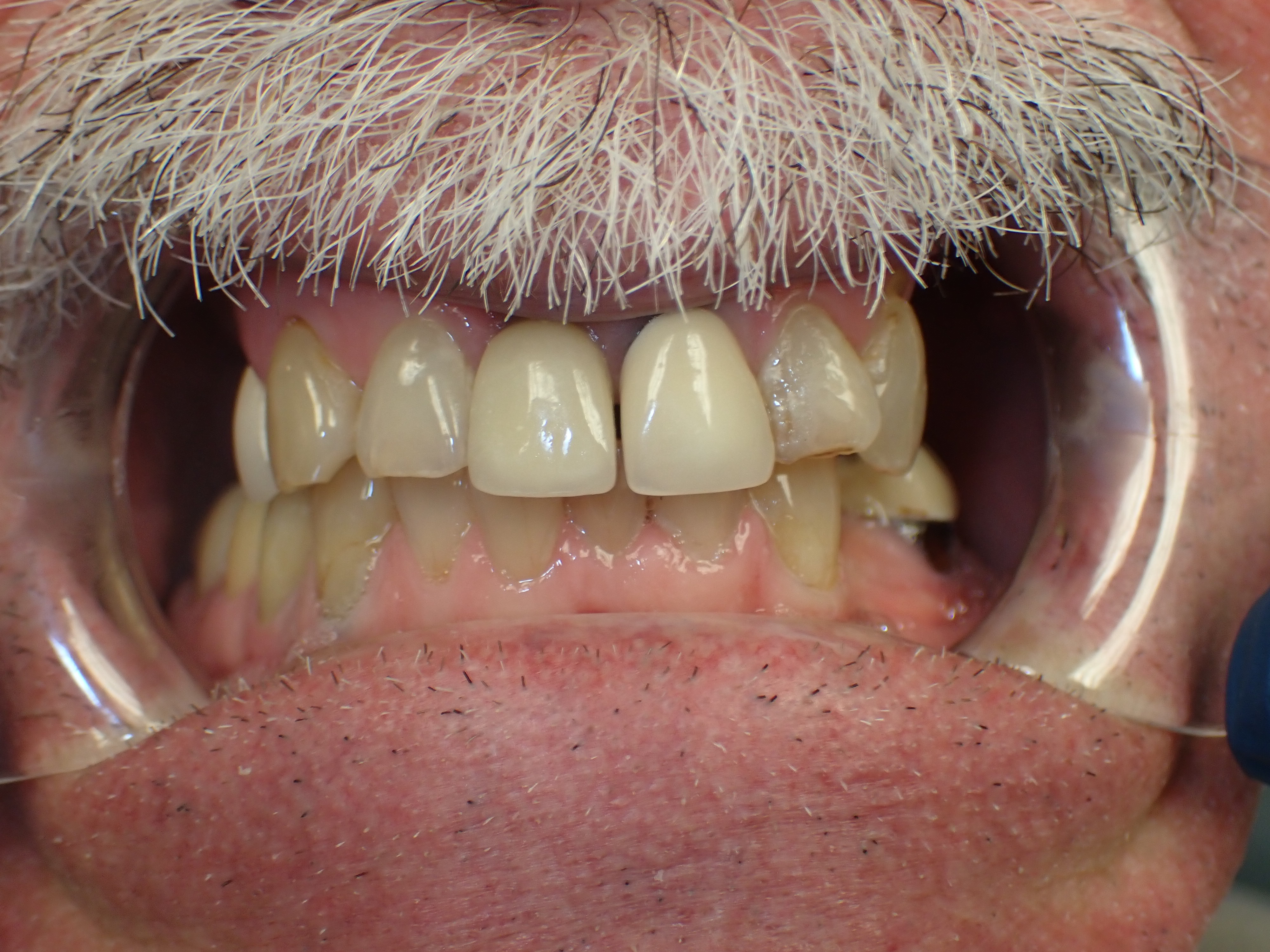 Mans smile prior to treatment