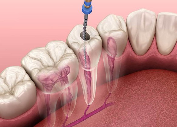 Illustration of root canal treatment in Wall Township, NJ