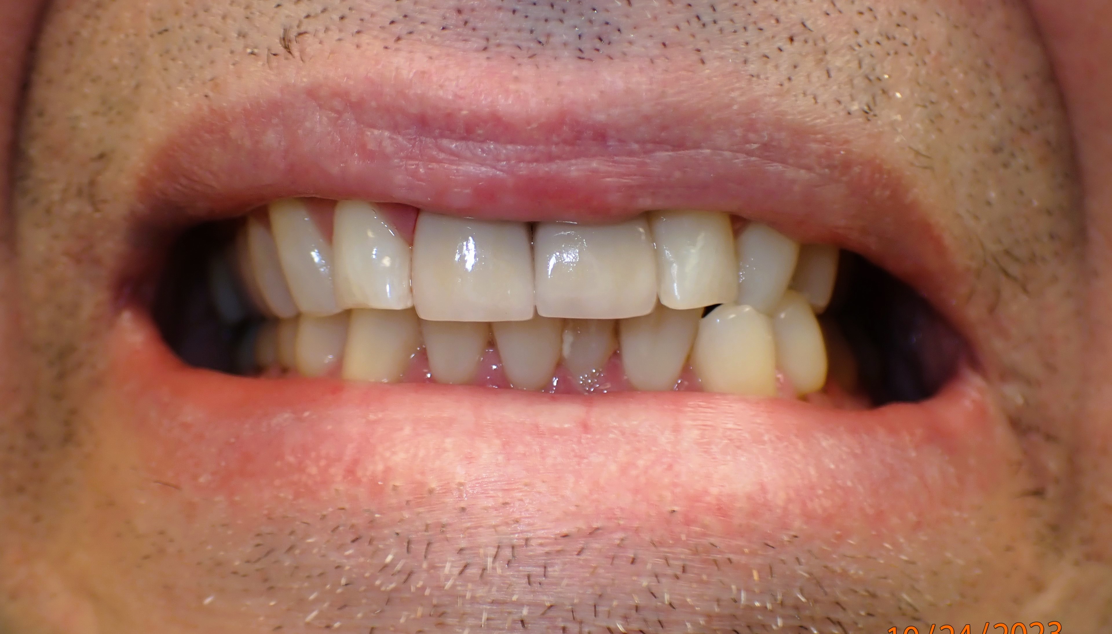 Close up of teeth after dental treatment