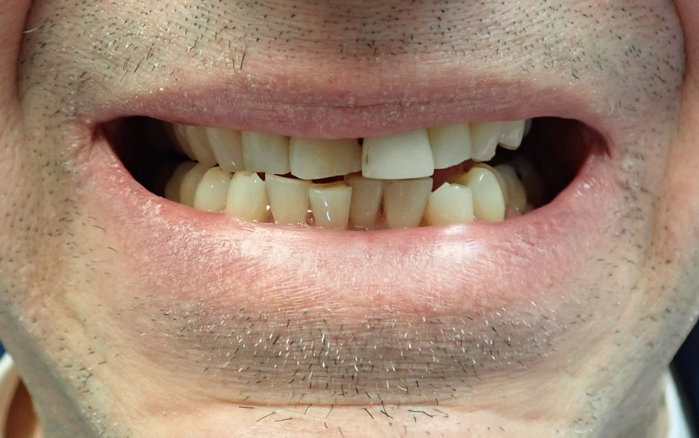 Multiple damaged and misaligned teeth