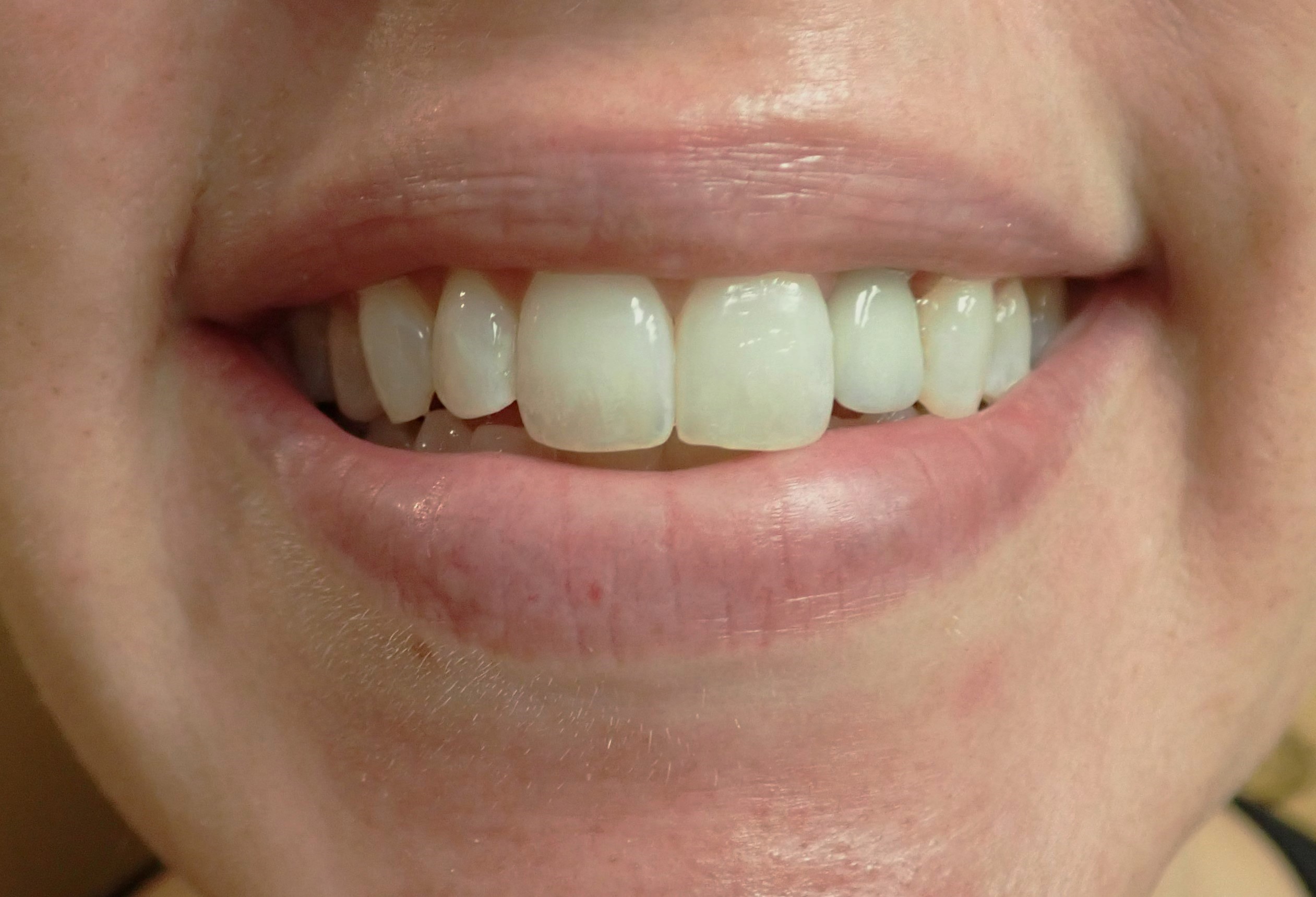 Smile with tooth replaced by dental implant