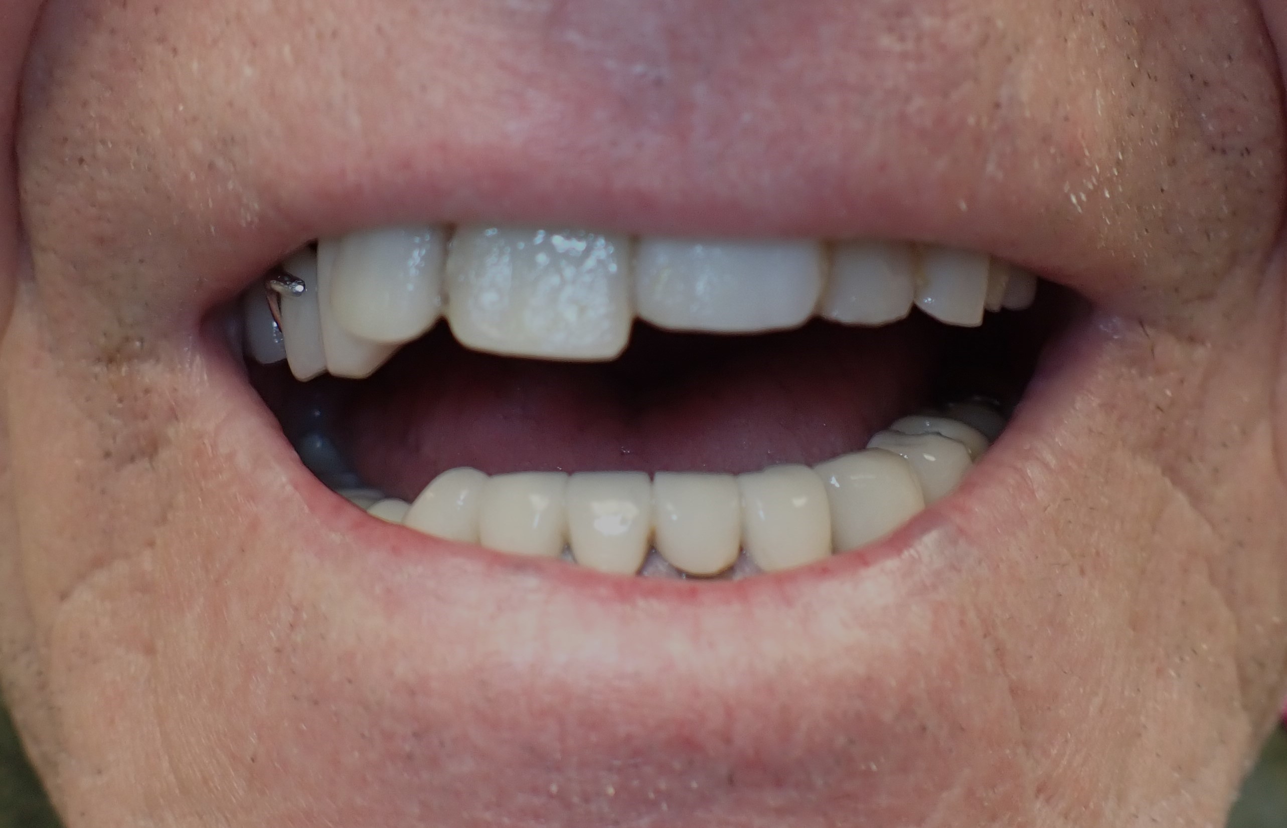 Patient with differently sized teeth