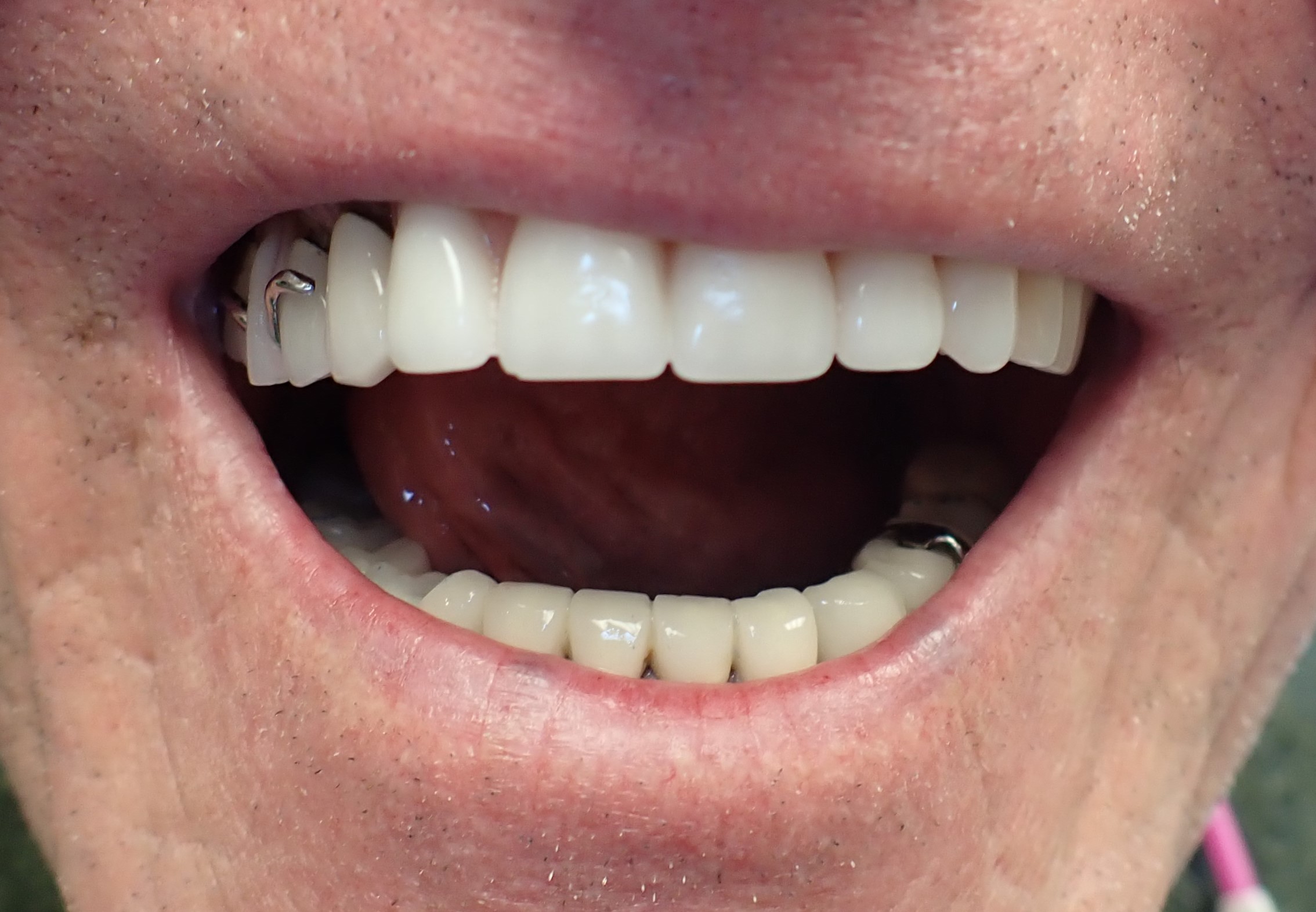 Patient smiling after getting implant dentures