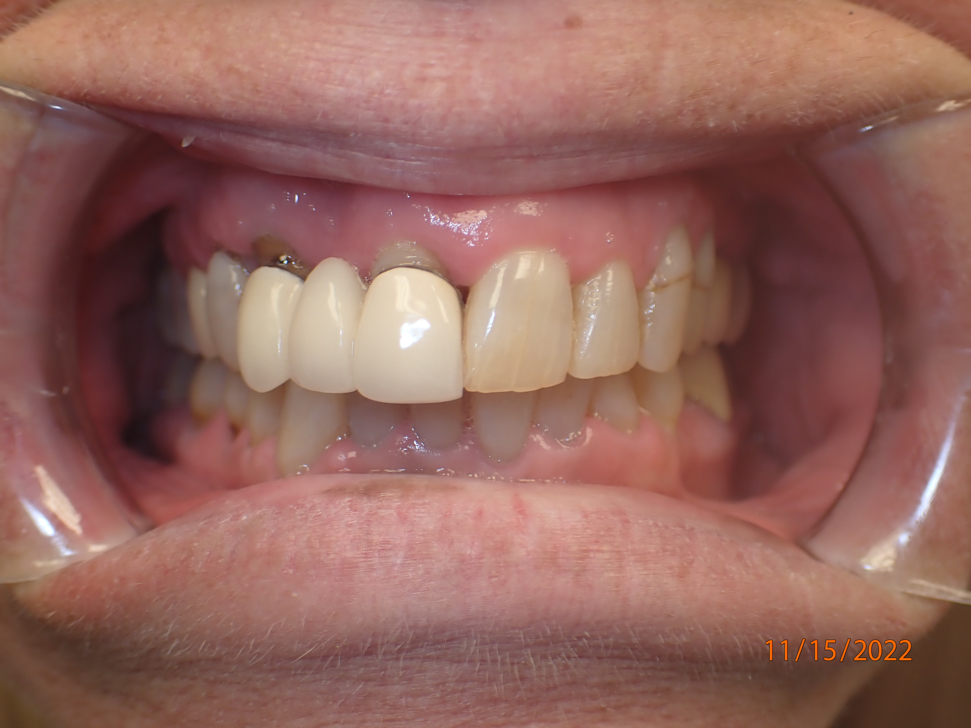 Close up of discolored teeth