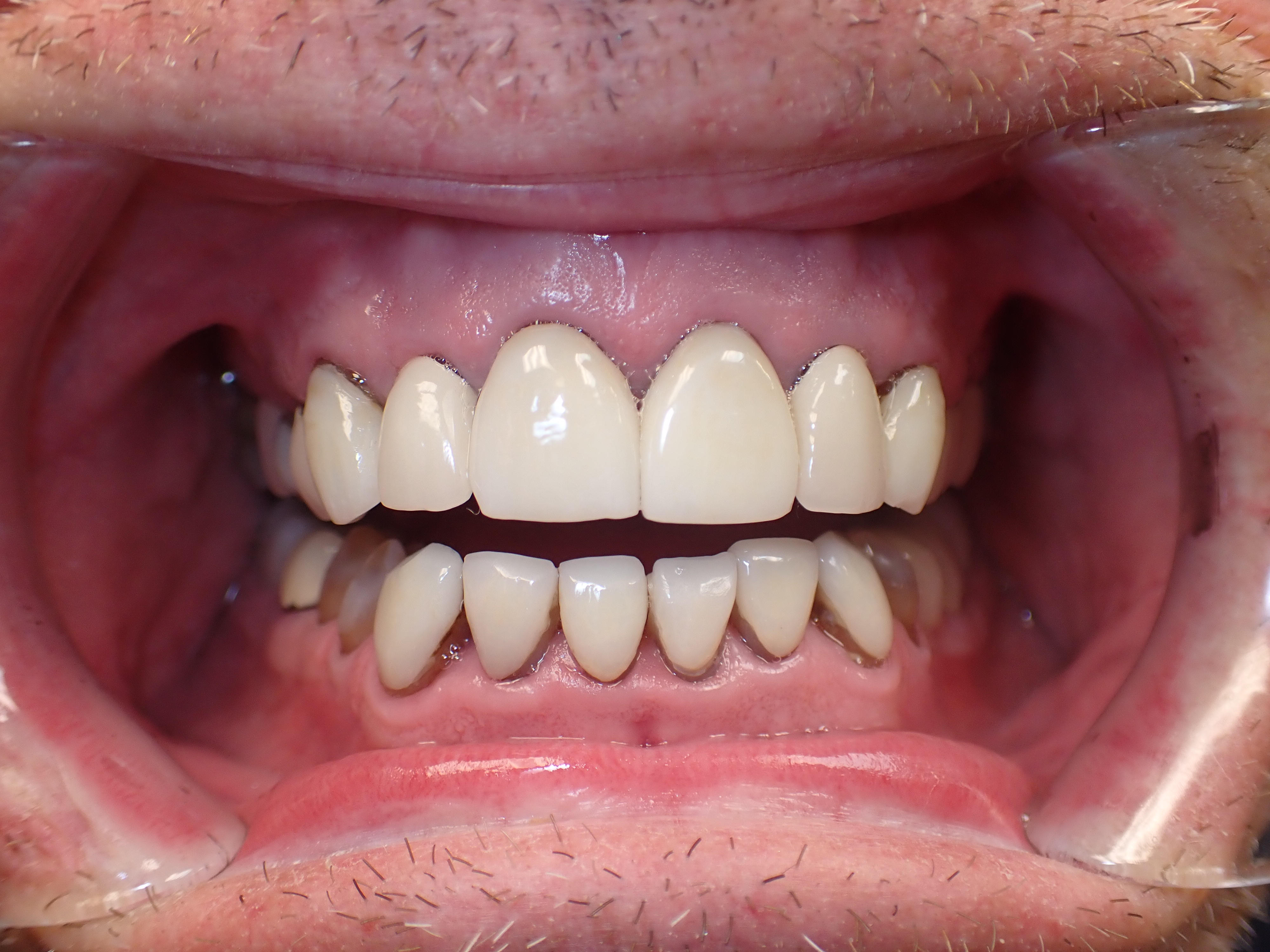 Close up of teeth with receded gums