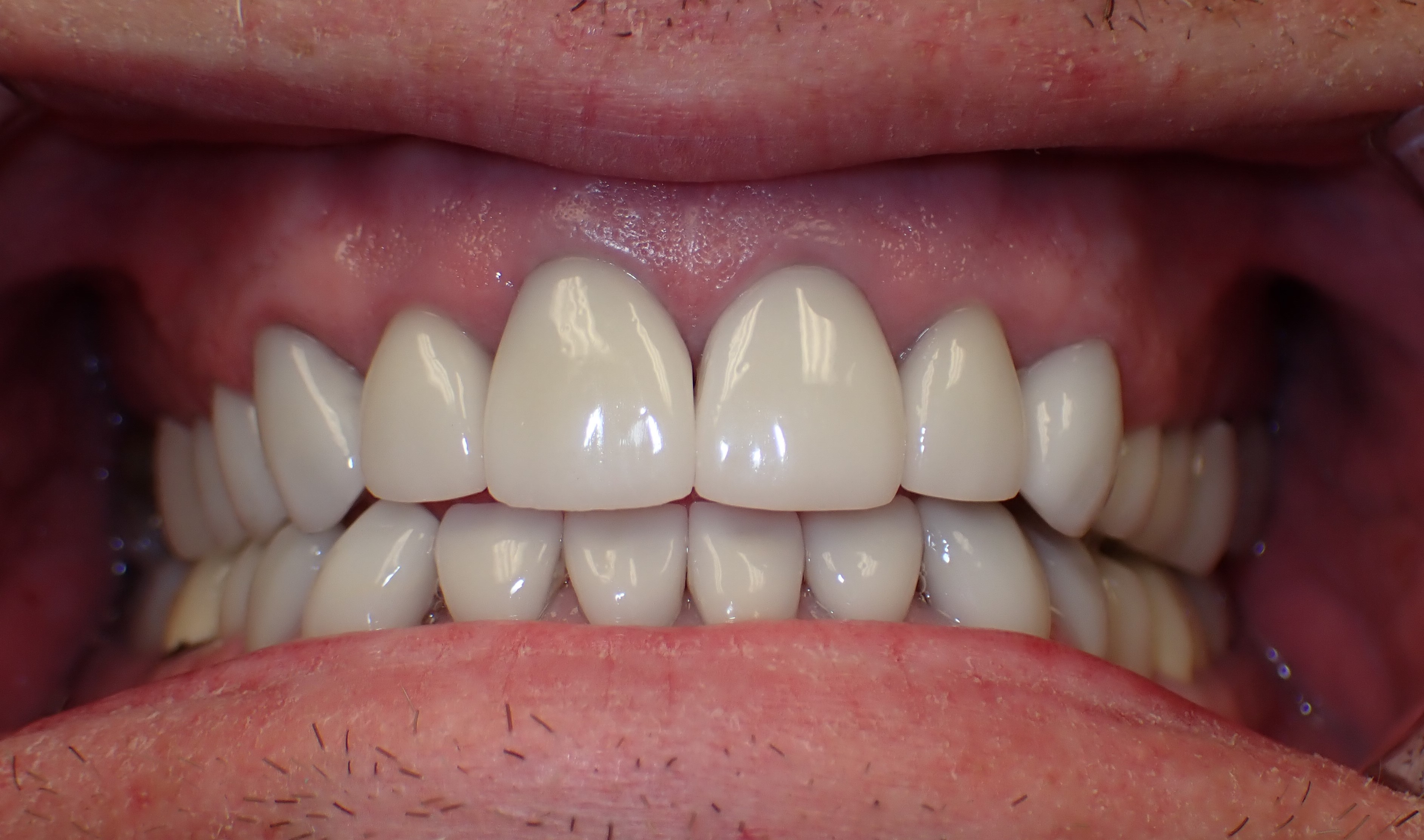 Close up of teeth after veneers have been placed