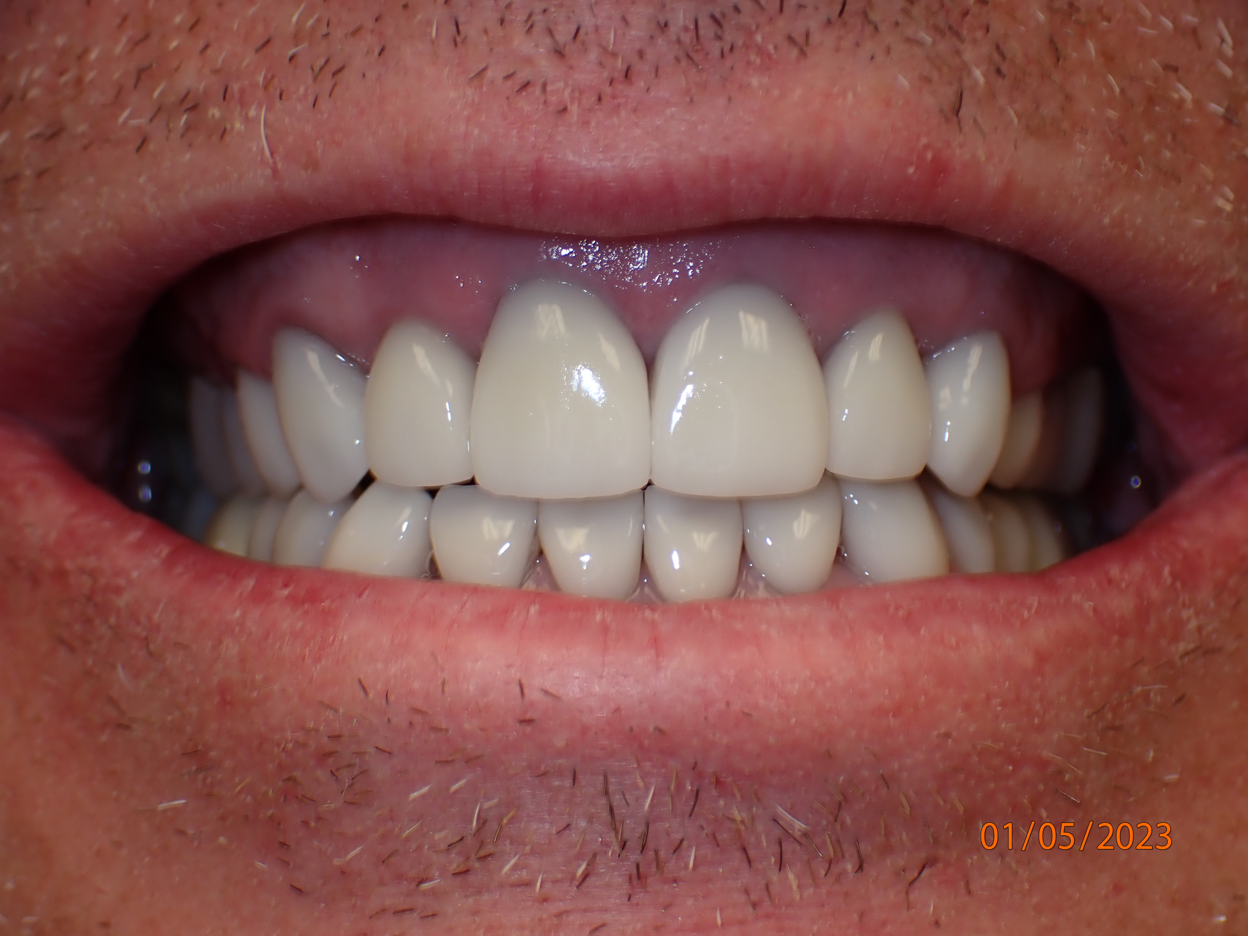 Smile improved by veneers